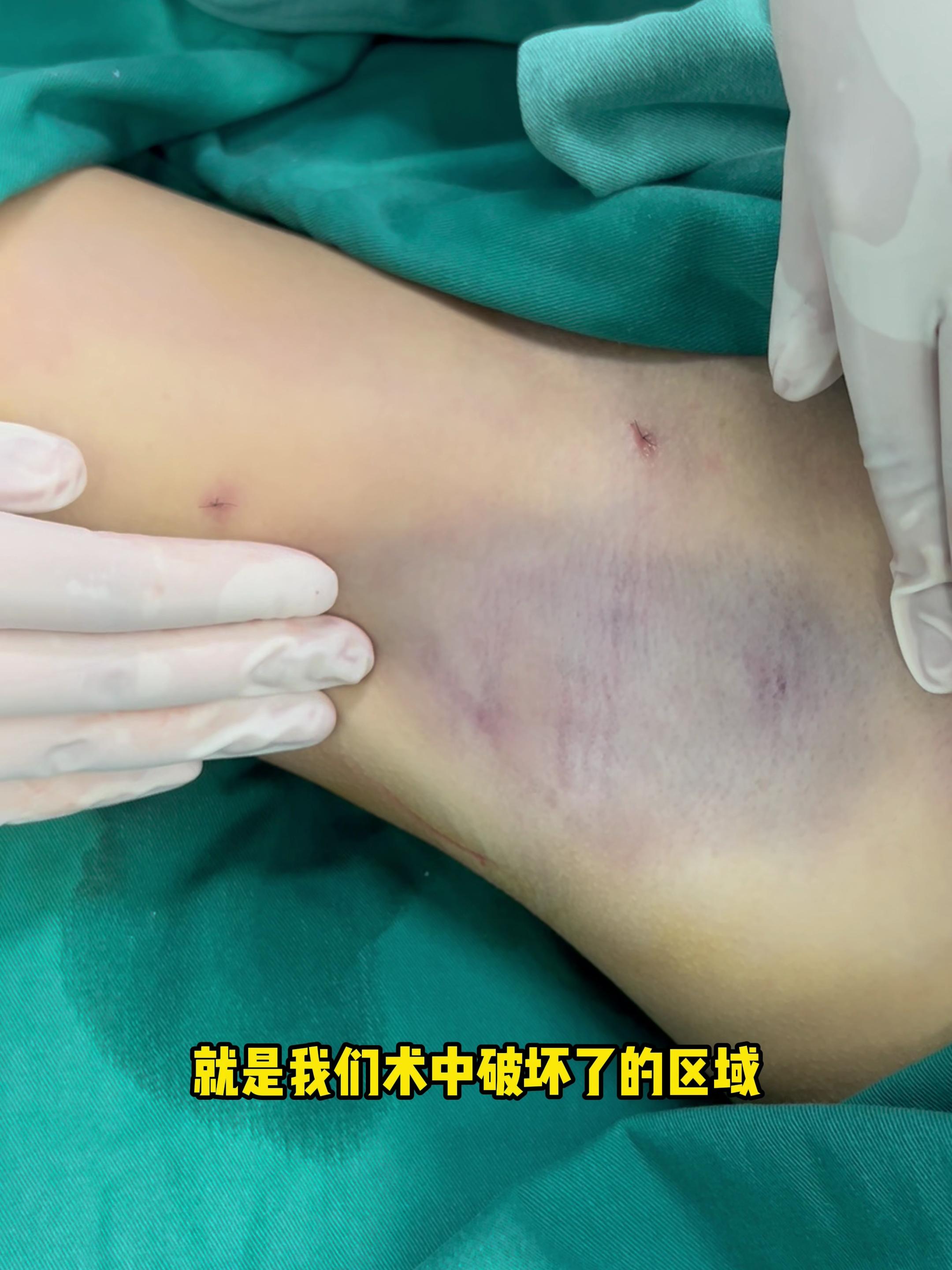 好后悔做了腋臭手术 好后悔做了腋臭手术