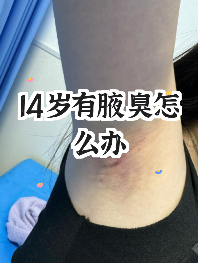 有狐臭的人腋下图片 有狐臭的人腋下图片