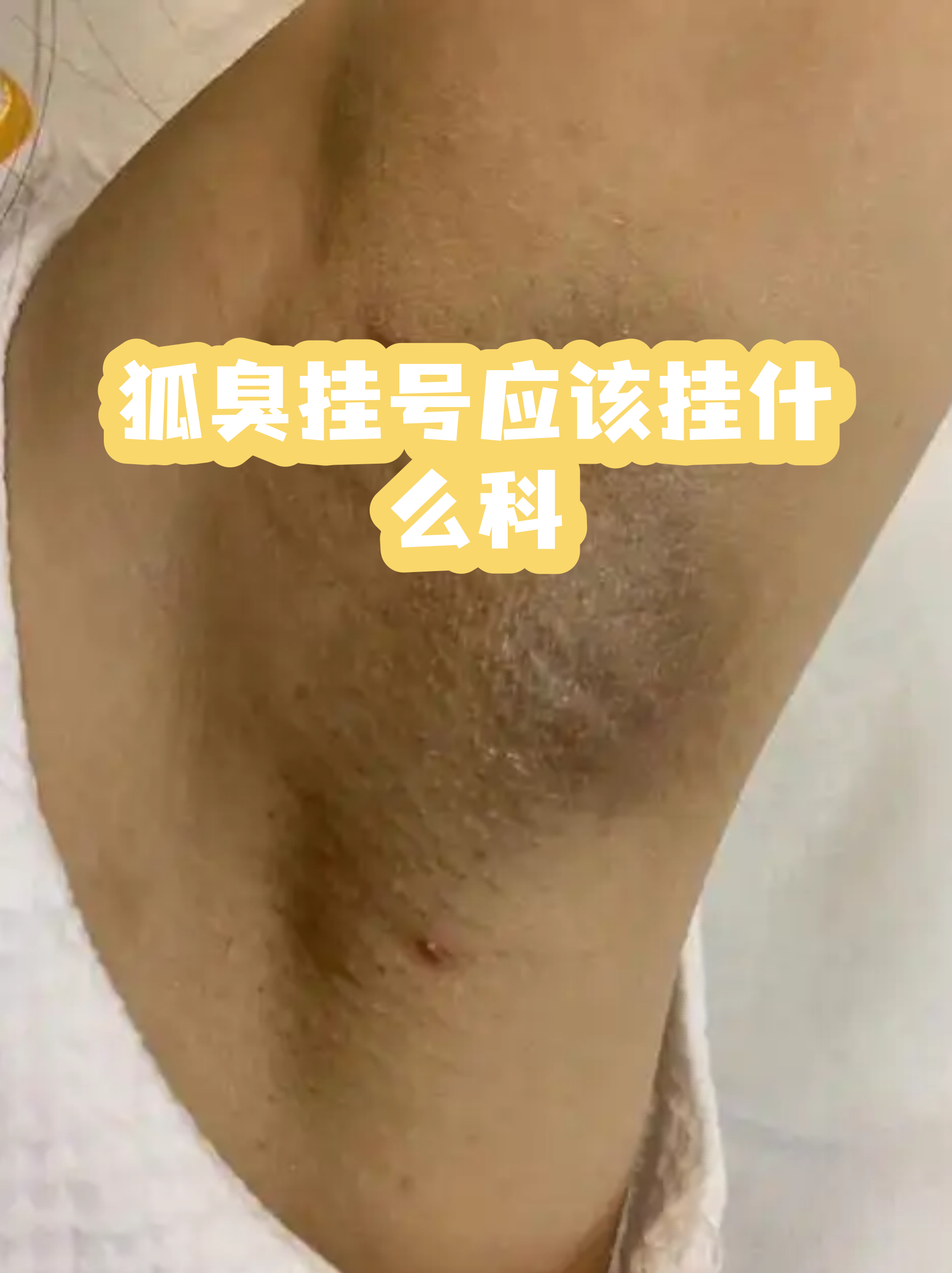 狐臭去医院挂科应该挂哪一科