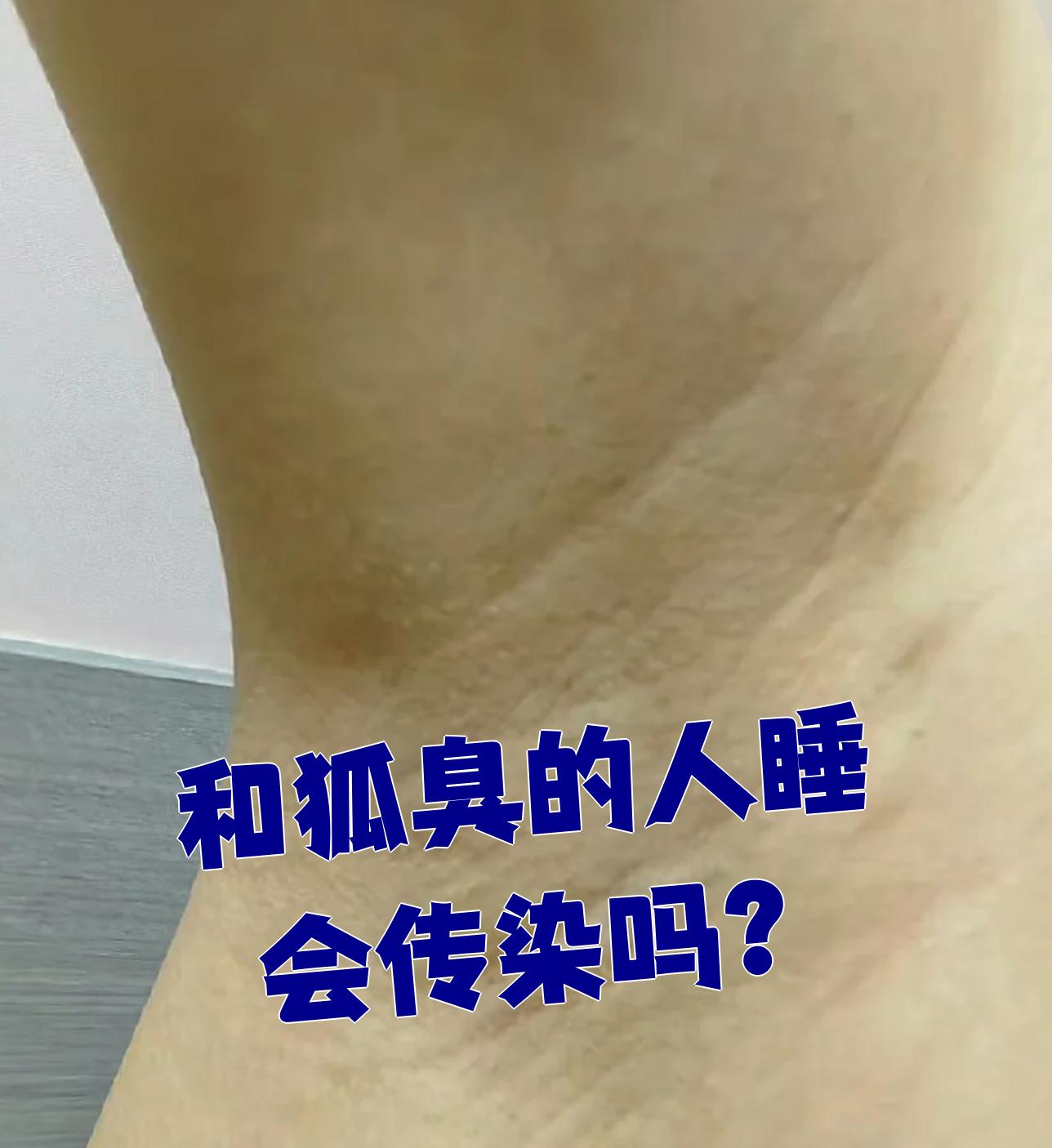 狐臭和正常人腋窝有区别吗
