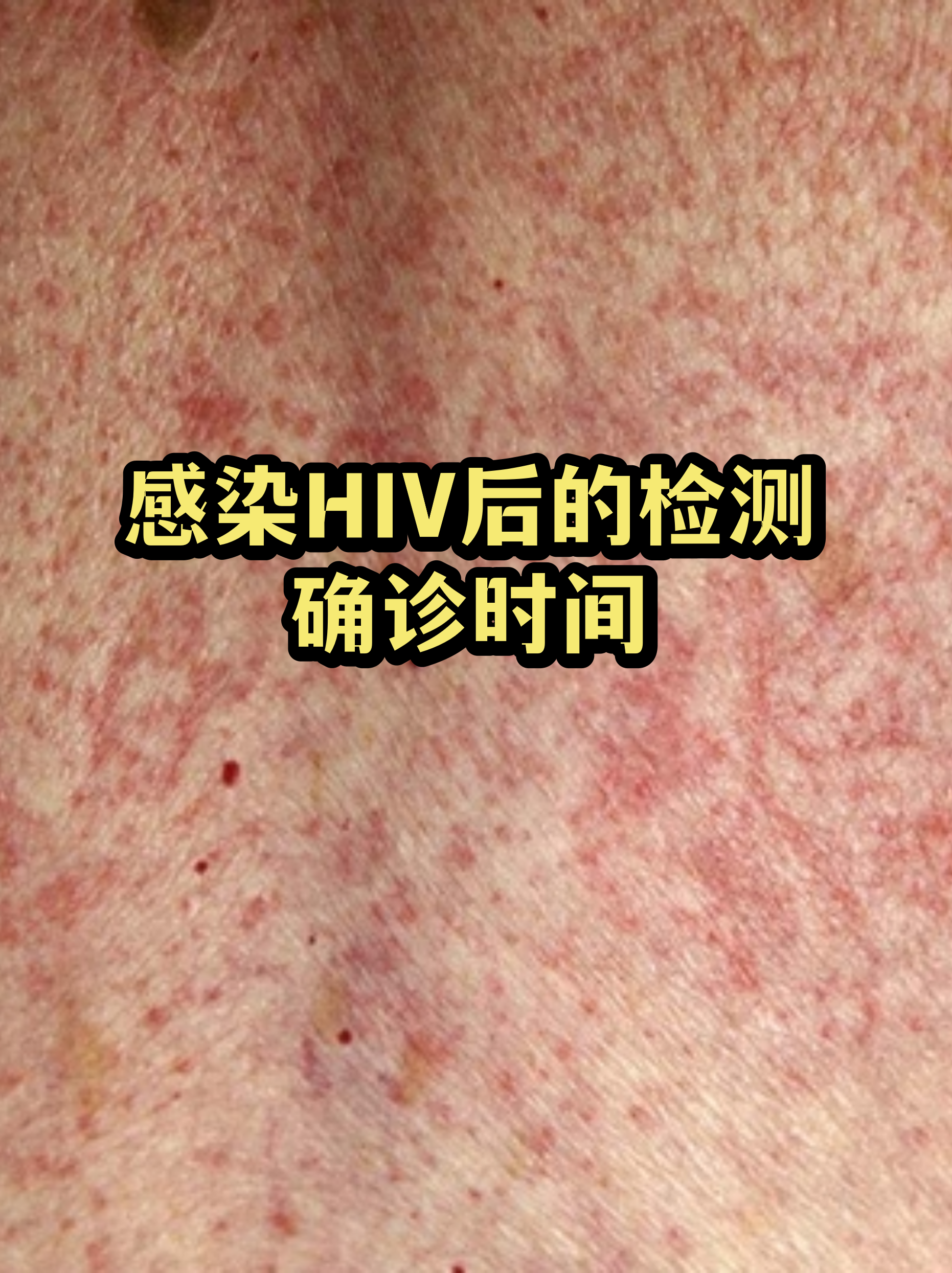hiv第四代多久能检测出来