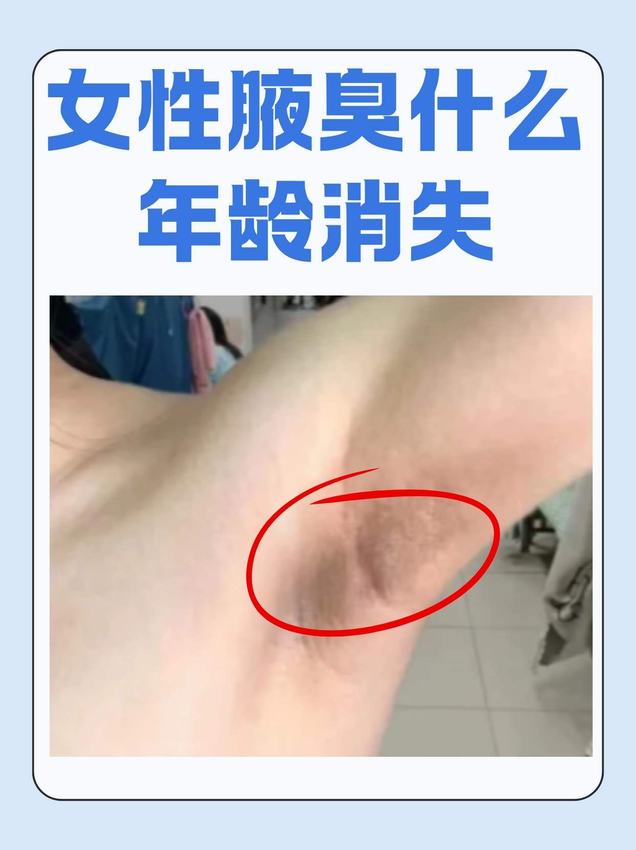 小孩做狐臭有年龄限制吗