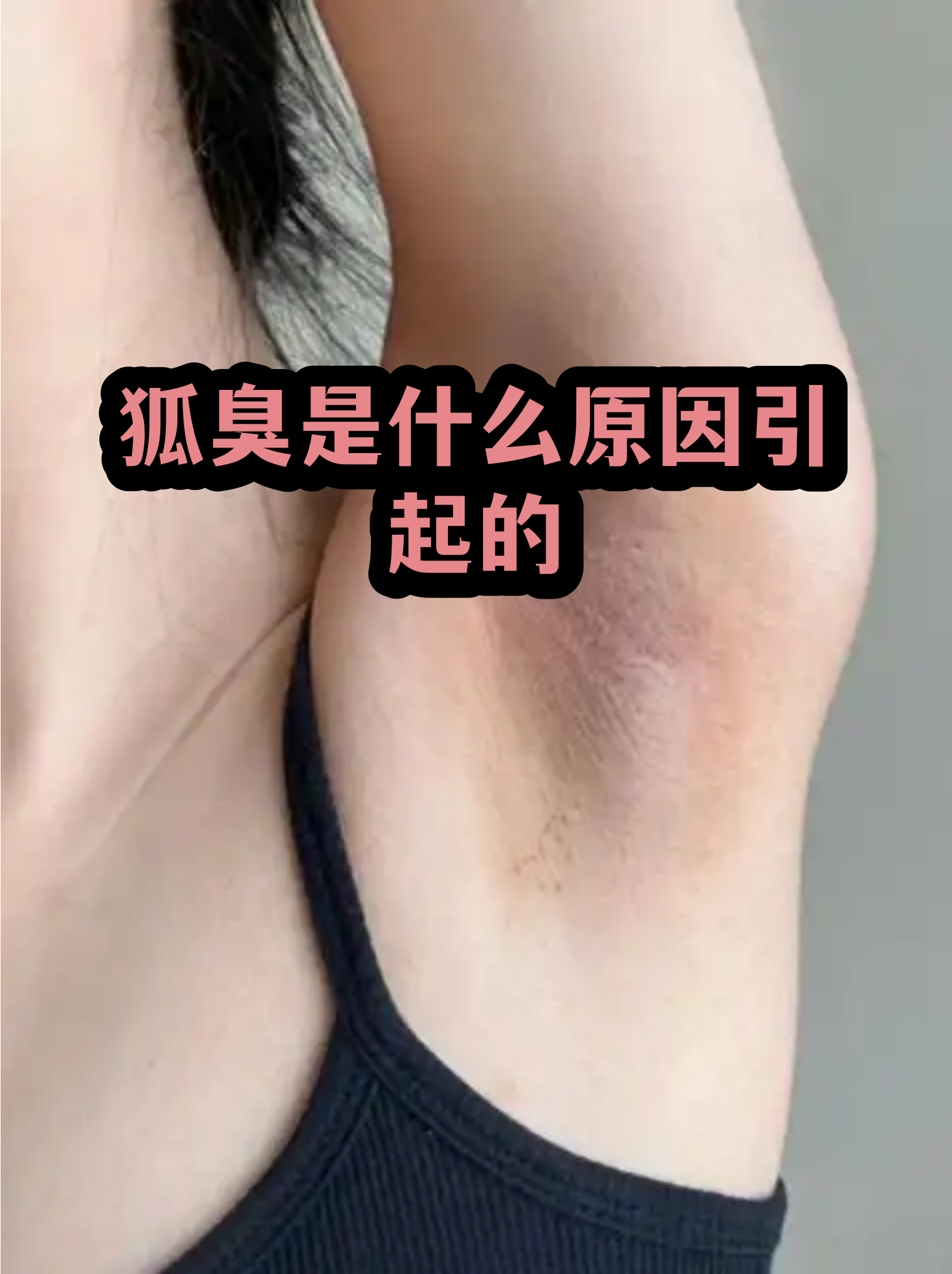 狐臭除了遗传还有其他途径患上吗(狐臭除了遗传还有其他途径患上吗图片) 狐臭除了遗传还有其他途径患上吗(狐臭除了遗传还有其他途径患上吗图片)