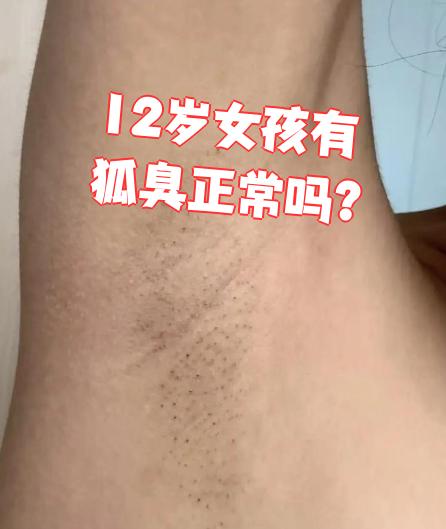 狐臭是正常的吗(狐臭是病还是正常生理现象) 狐臭是正常的吗(狐臭是病还是正常生理现象)