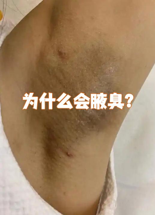 腋下脱毛会引起狐臭吗(脱腋下的毛会引起狐臭吗) 腋下脱毛会引起狐臭吗(脱腋下的毛会引起狐臭吗)