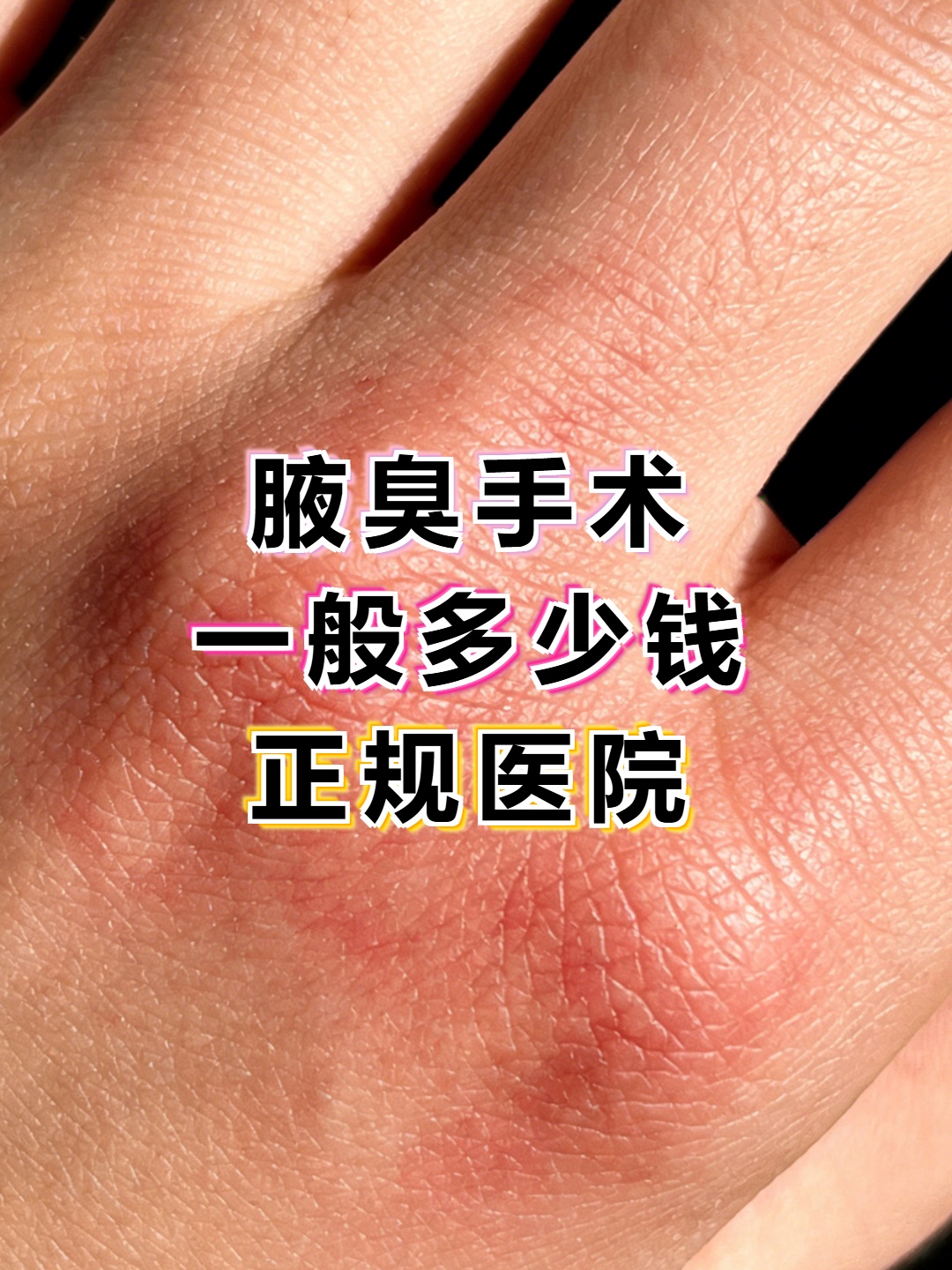 腋臭手术可以走医保吗多少钱(腋臭手术可以走医保吗多少钱啊)