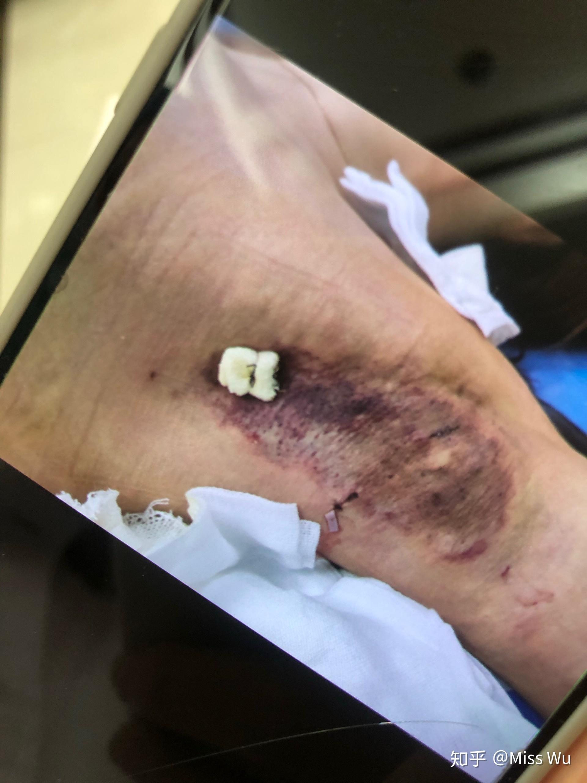 狐臭手术后多久可以洗澡(狐臭手术后多久可以剧烈运动)