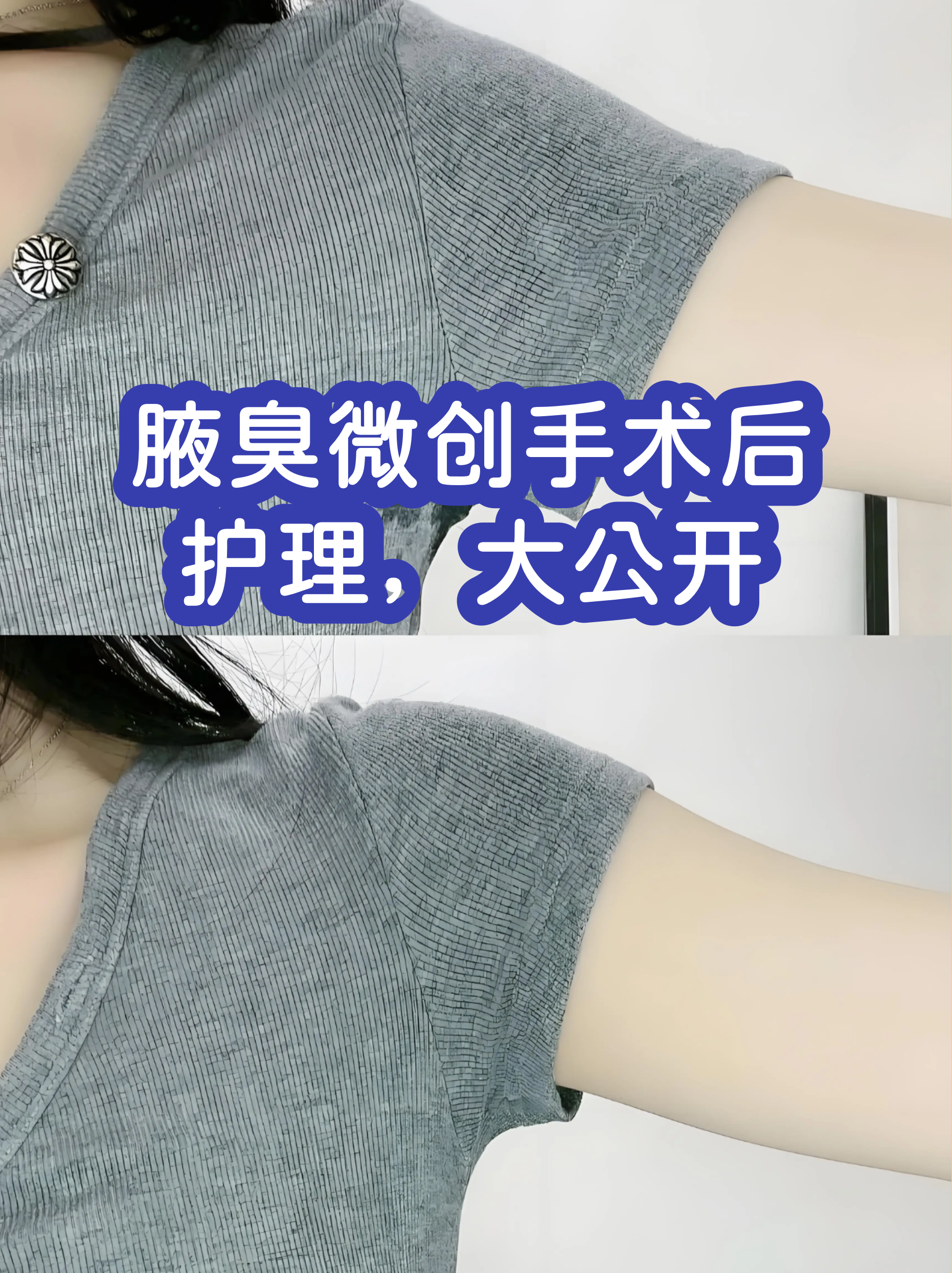 狐臭可以做手术根除吗(狐臭可以做手术根除吗,会复发吗) 狐臭可以做手术根除吗(狐臭可以做手术根除吗,会复发吗)