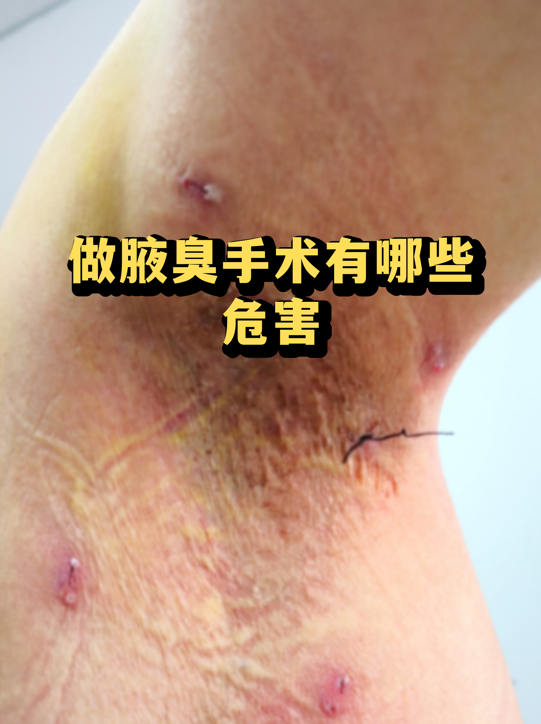 狐臭有什么危害(狐臭的危害有哪些)
