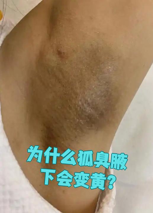 狐臭和正常人腋窝图片对比(狐臭和正常人腋窝图片对比大全) 狐臭和正常人腋窝图片对比(狐臭和正常人腋窝图片对比大全)