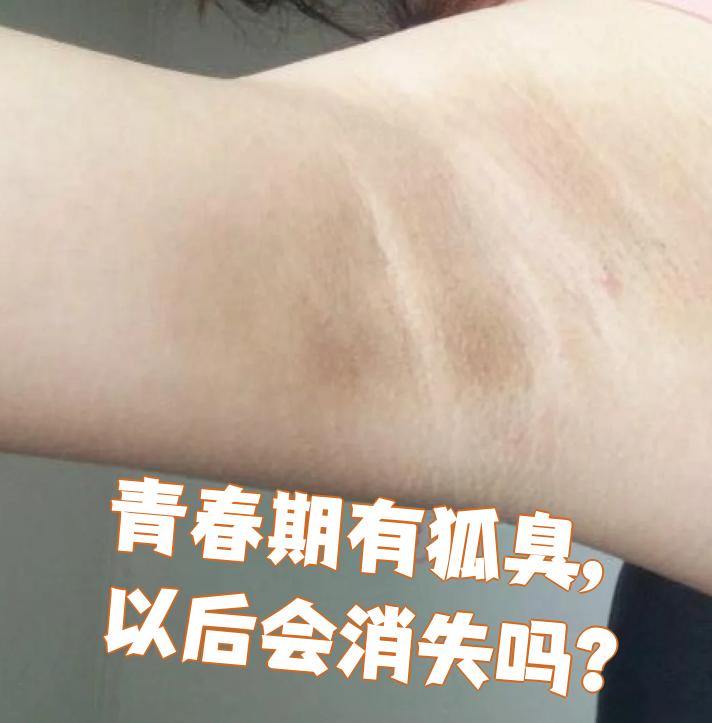 狐臭患者有什么特征(狐臭有什么明显的特征)