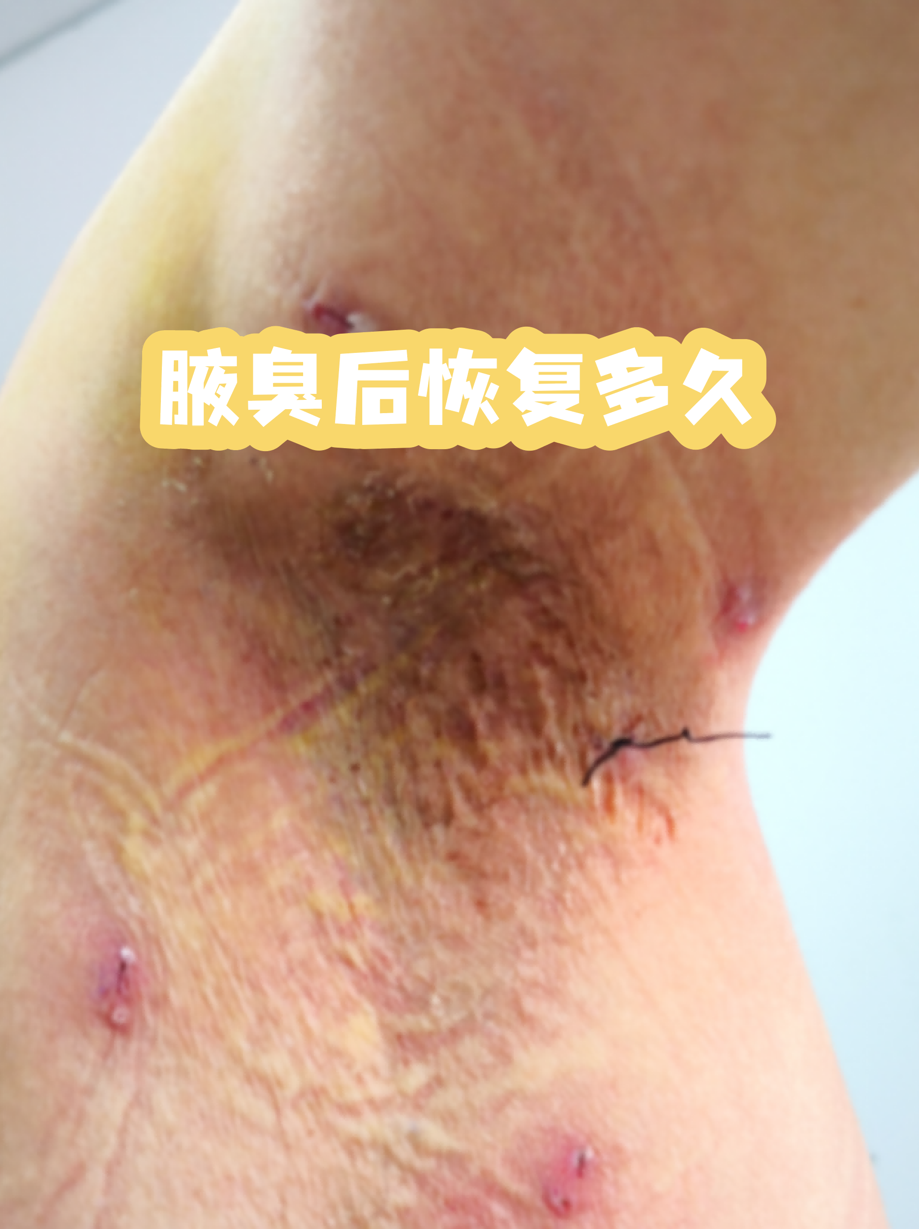 为什么腋臭不建议做手术(为什么腋臭不建议做手术府谷县天气预报)