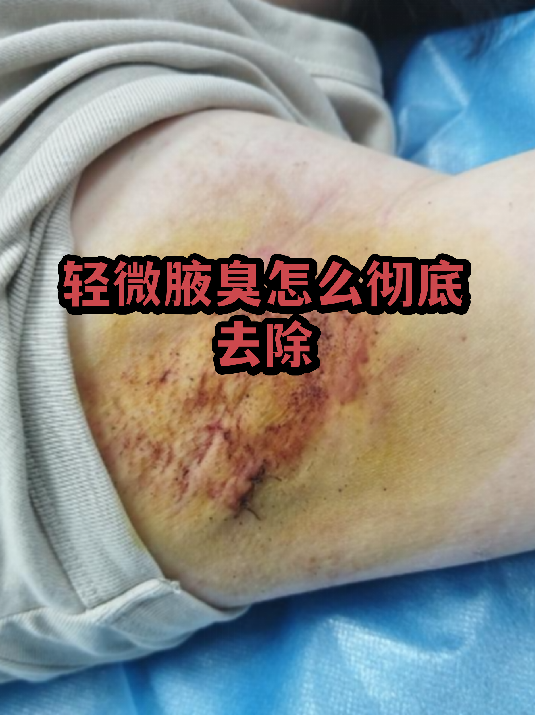 去除腋臭最有效的方法(12岁儿童腋臭如何治疗)