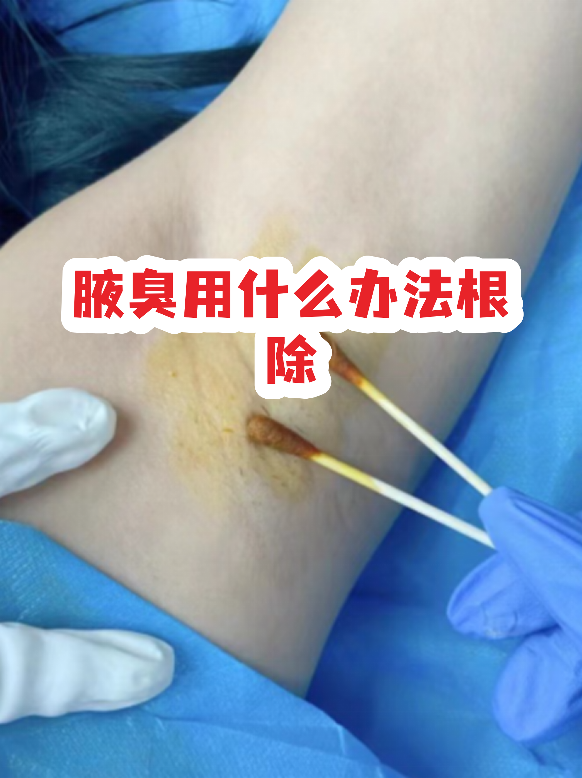 去除腋臭最有效的方法(12岁儿童腋臭如何治疗)