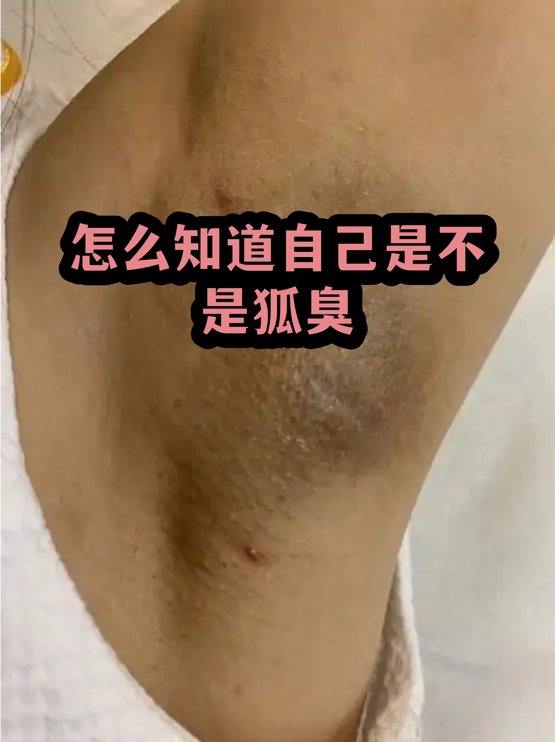 狐臭和腋臭有什么区别(狐臭怎样治疗才彻底根除)