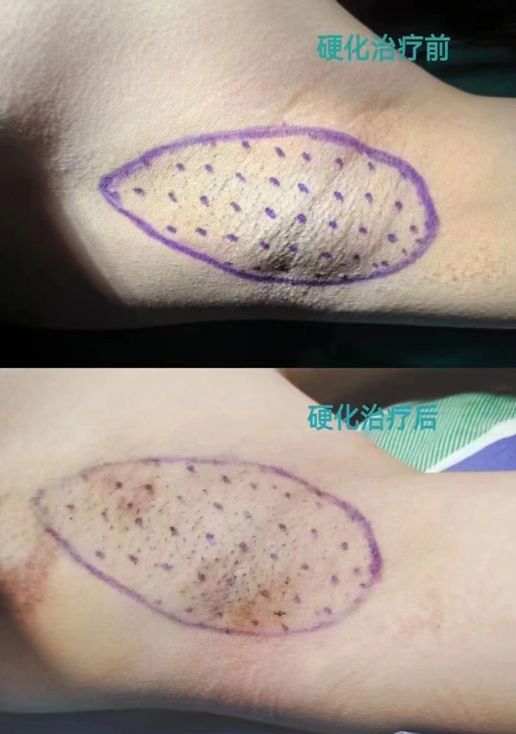 腋臭手术后不用药能自愈吗(腋臭手术后可以更快的恢复吗)