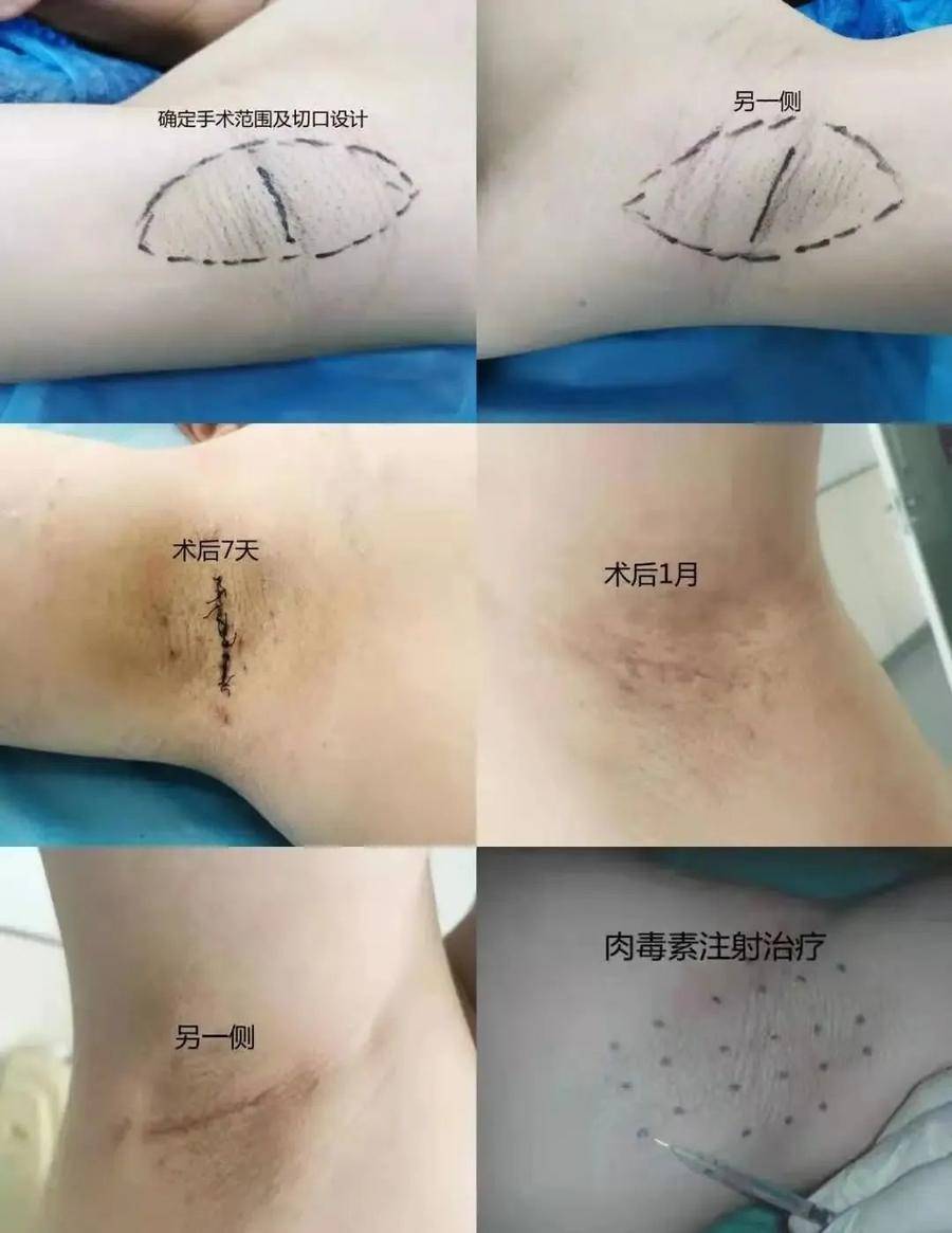 狐臭民间治疗方法(狐臭治疗方法和费用)