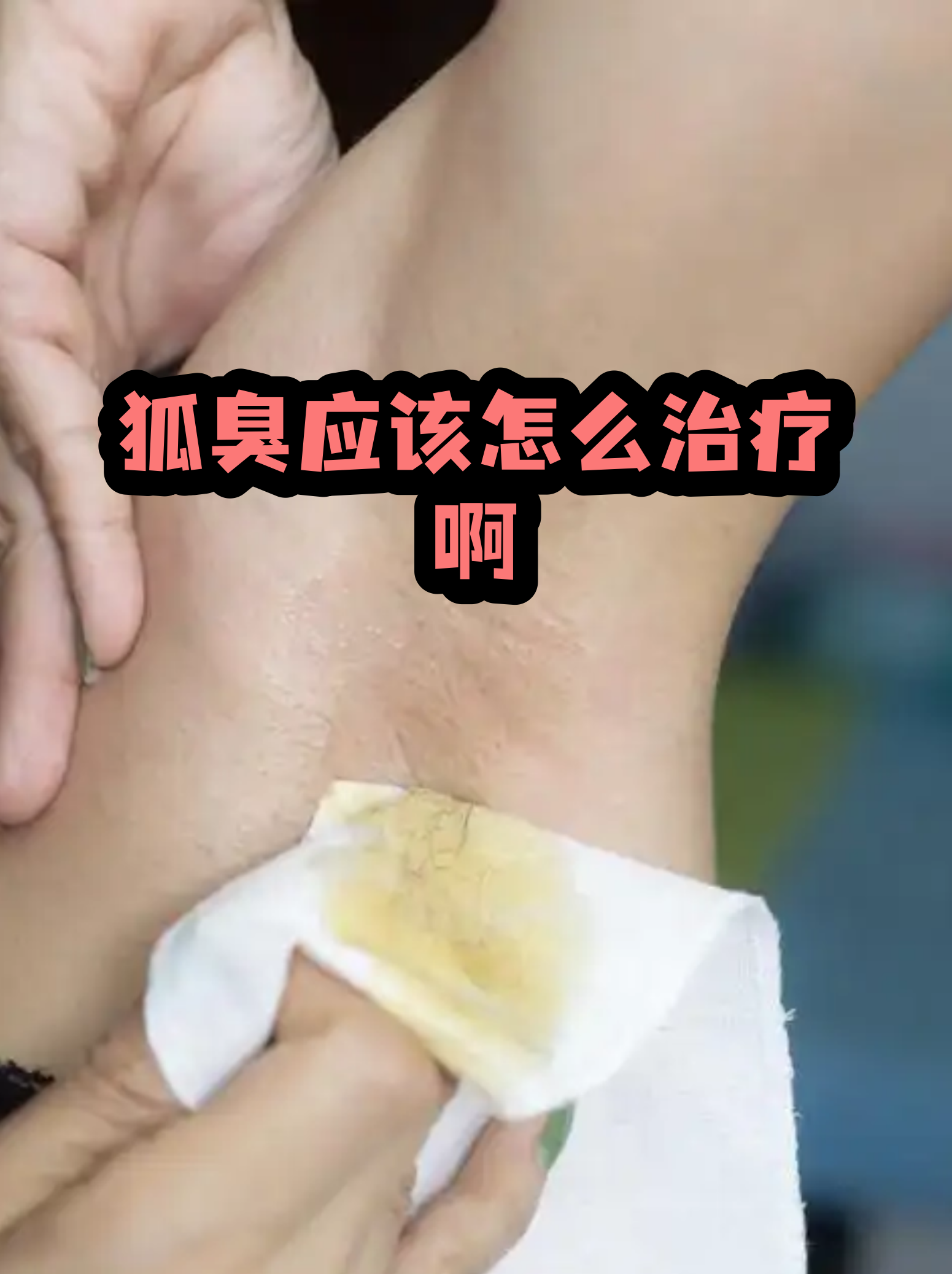 狐臭民间治疗方法(狐臭治疗方法和费用)