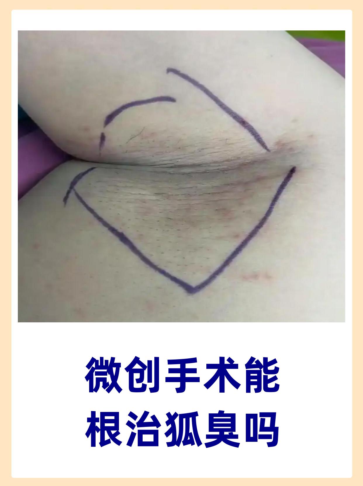狐臭手术可以永久除根吗(狐臭手术可以永久除根吗会复发吗) 狐臭手术可以永久除根吗(狐臭手术可以永久除根吗会复发吗)
