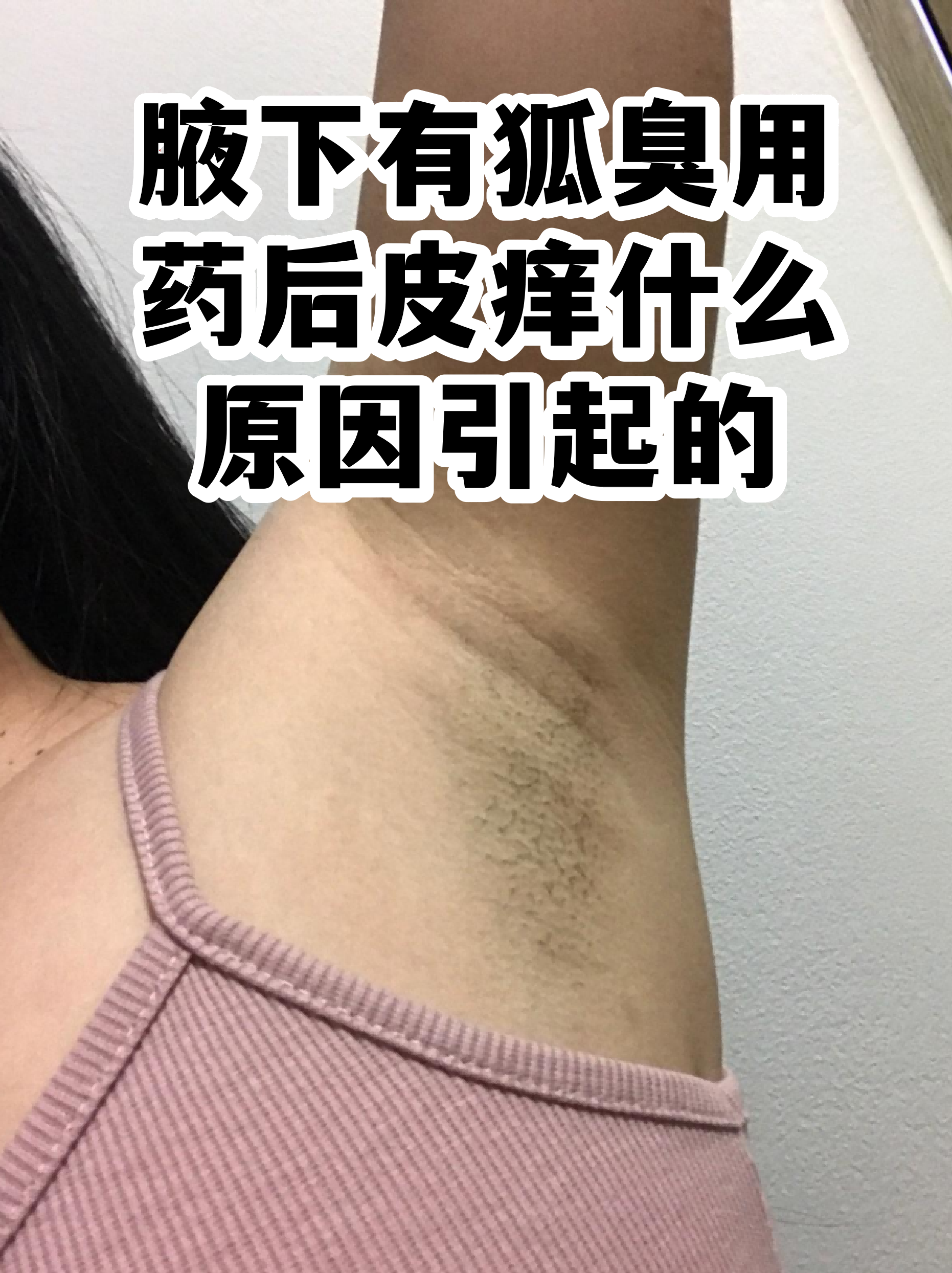 狐臭与正常腋窝图(狐臭的腋窝毛囊炎图片) 狐臭与正常腋窝图(狐臭的腋窝毛囊炎图片)