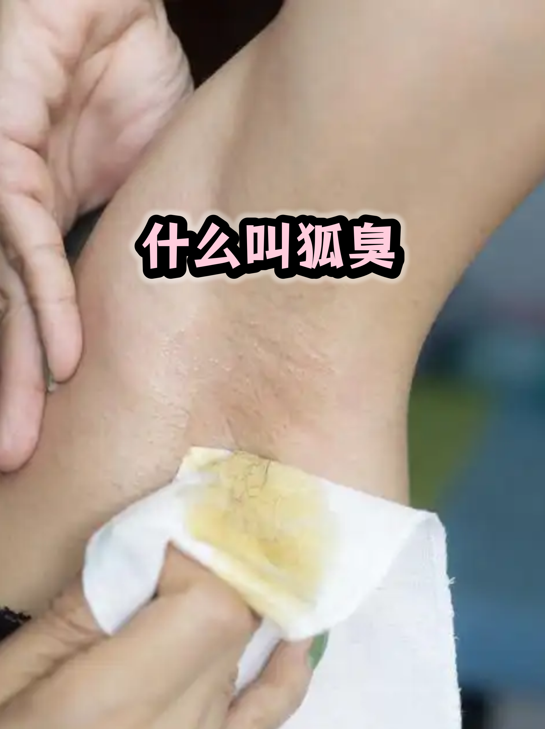 狐臭和正常人腋窝图片原理图(狐臭和正常人腋窝图片原理图对比)