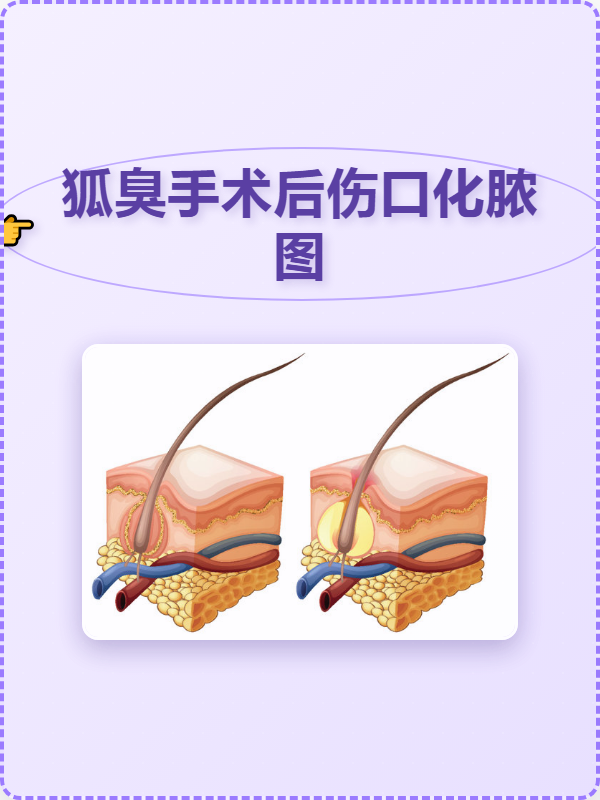 狐臭手术创口有多大(狐臭手术20天了刀口皮还没长好)