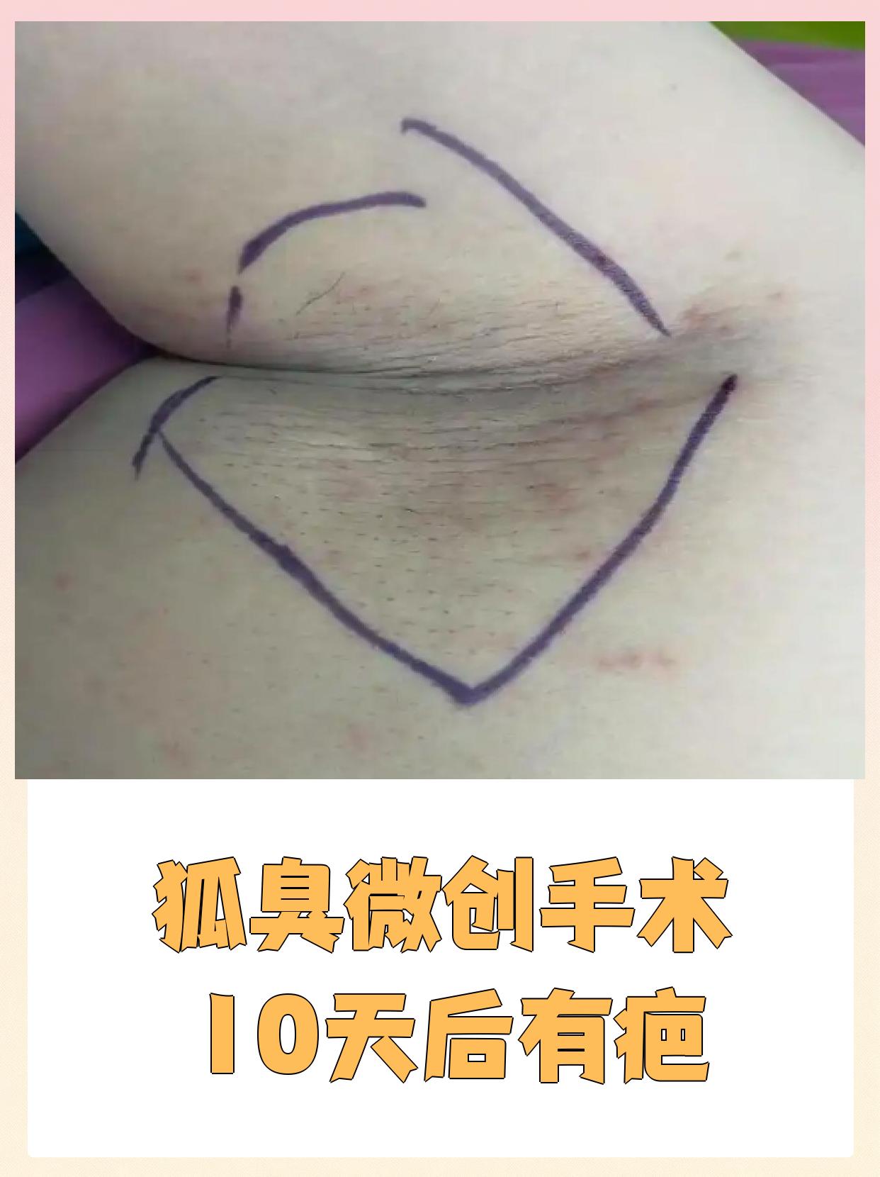 狐臭微创手术可以彻底根治吗(狐臭微创手术可以彻底根治吗多少钱)