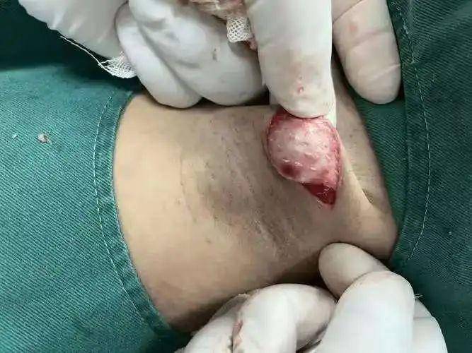 狐臭腋下照片展示(狐臭腋下有什么特征图)