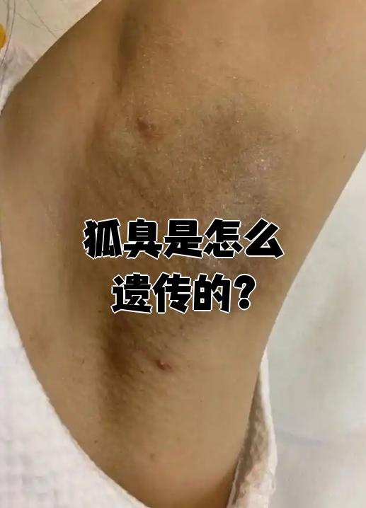 狐臭的女孩子会遗传吗(女的狐臭遗传给男孩多还是女孩多)