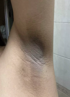有狐臭的人腋下有什么症状吗(有狐臭的人腋下有什么症状吗图片)