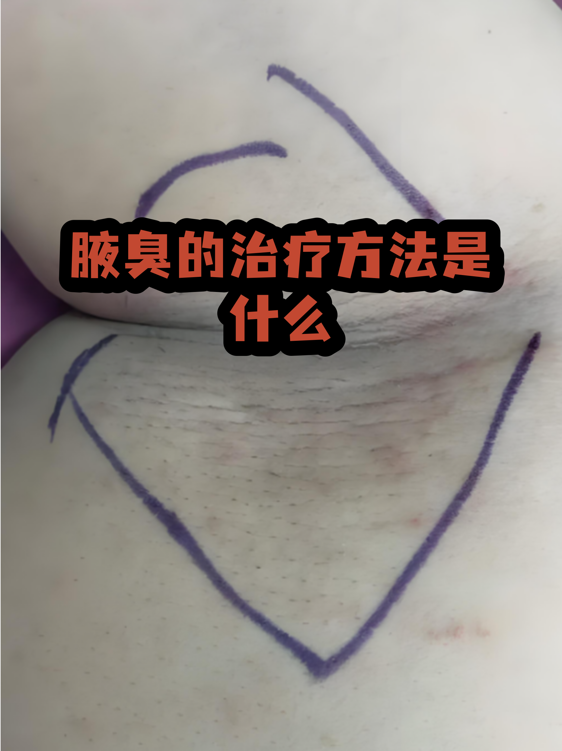 有狐臭的人腋下有什么症状吗(有狐臭的人腋下有什么症状吗图片) 有狐臭的人腋下有什么症状吗(有狐臭的人腋下有什么症状吗图片)