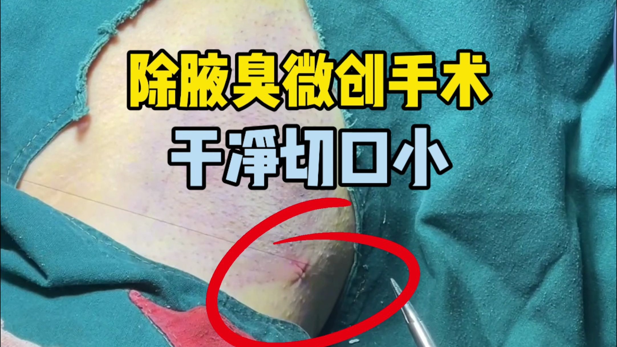 狐臭手术一般要多少(狐臭手术一般多少岁才可以做)