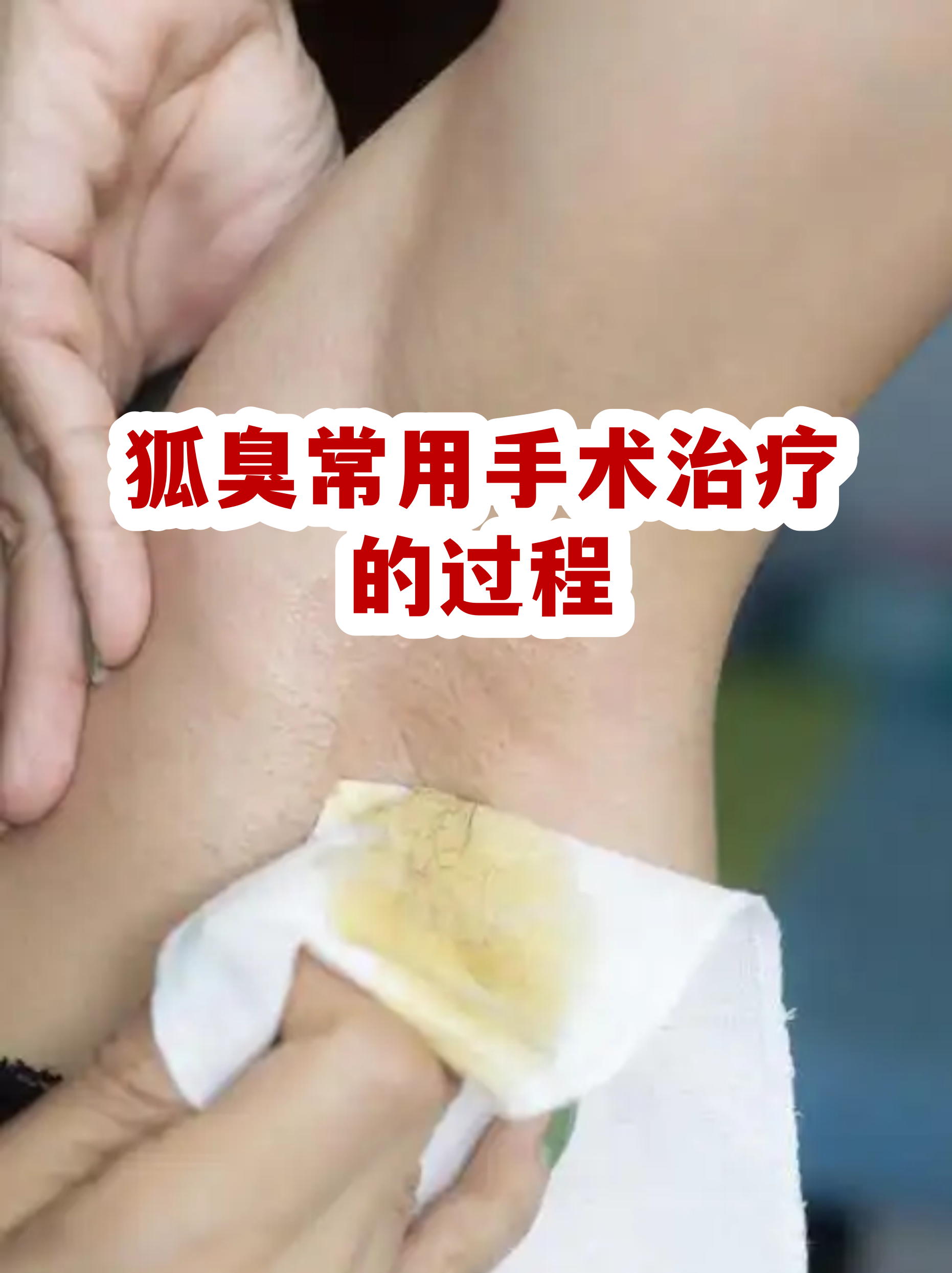 狐臭手术一般要多少(狐臭手术一般多少岁才可以做) 狐臭手术一般要多少(狐臭手术一般多少岁才可以做)