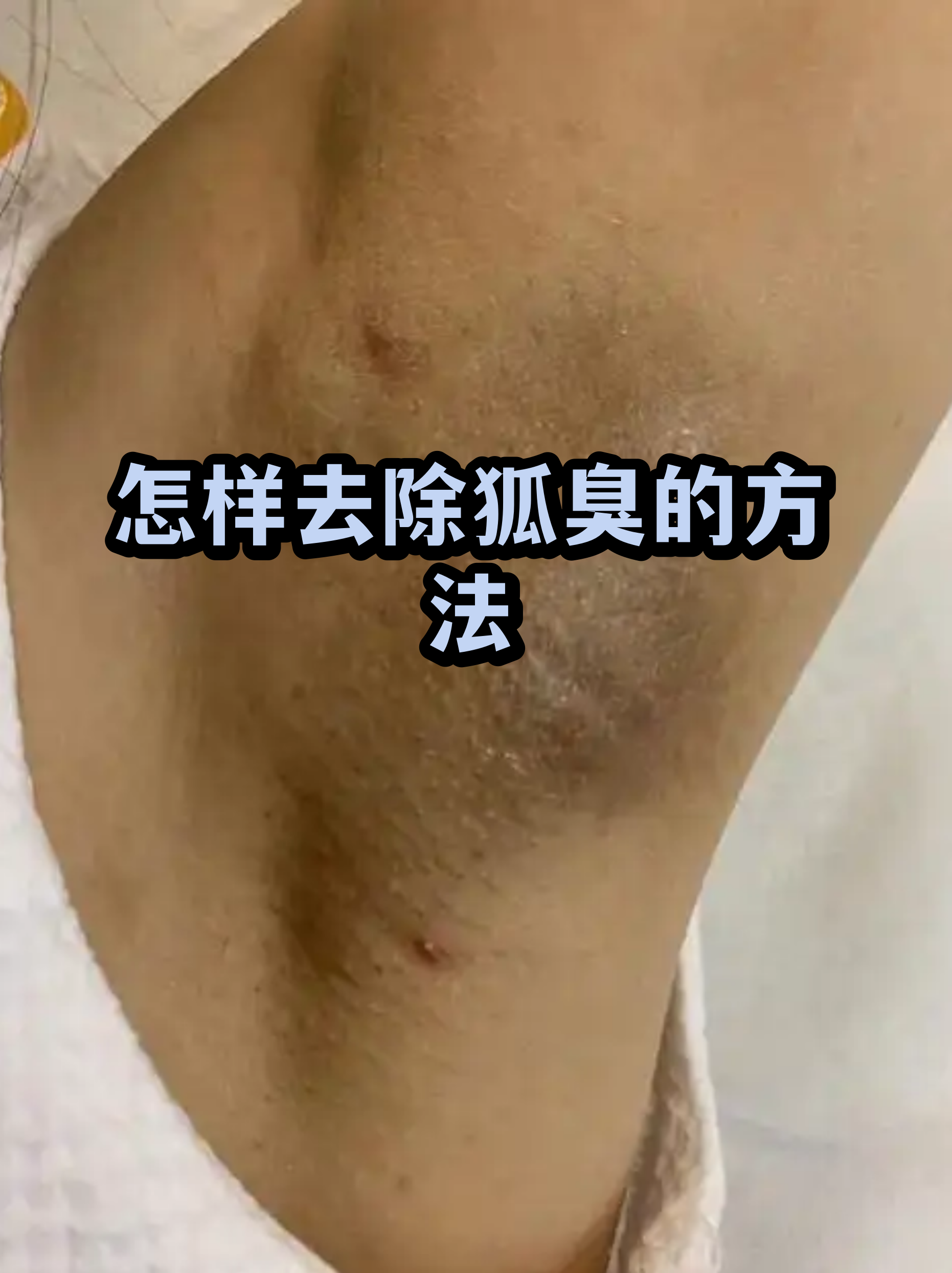 狐臭会后来产生的吗(狐臭会后来产生的吗女性)