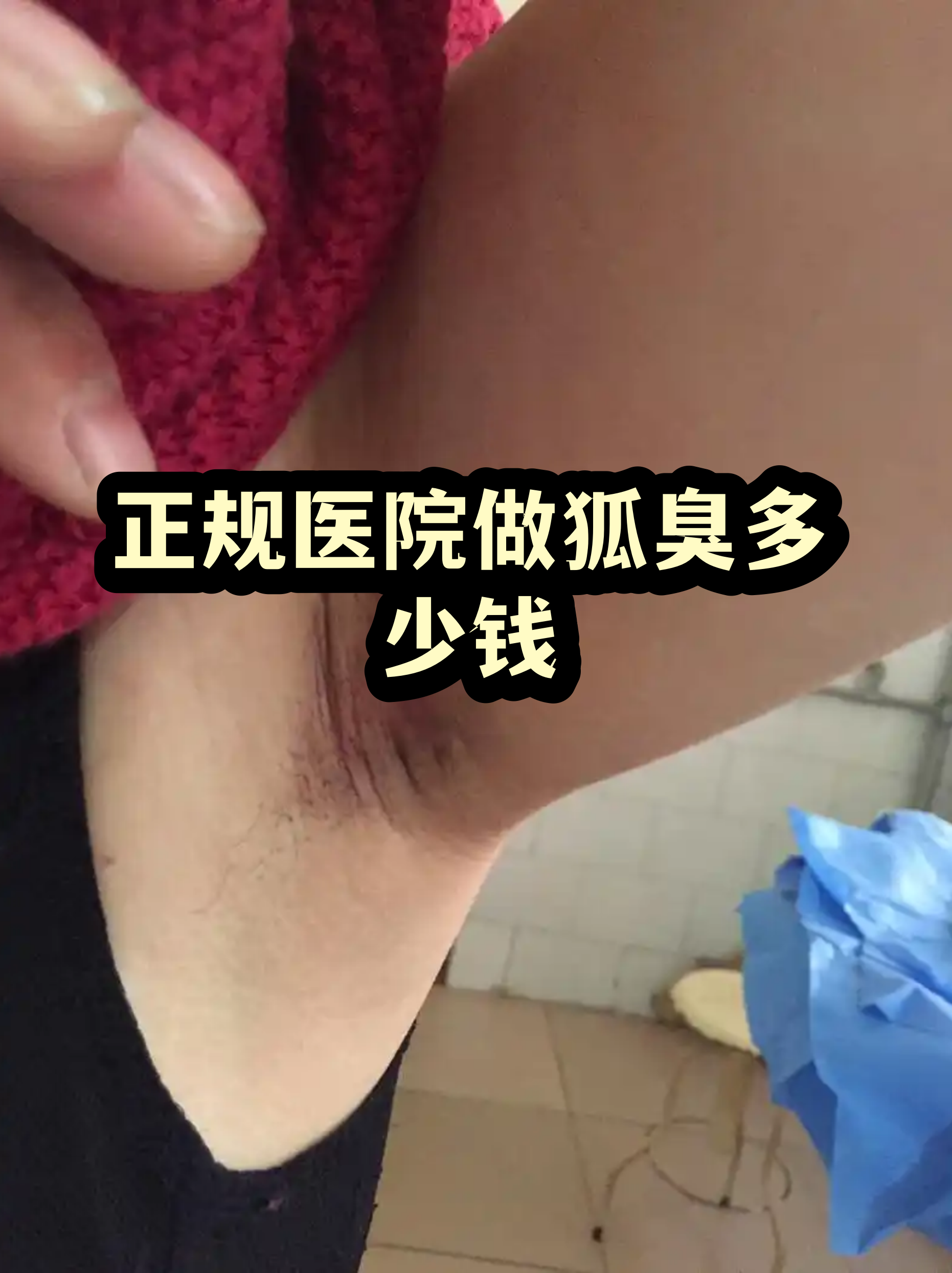 哈尔滨狐臭手术多少钱(割狐臭需要多少钱的手术费哈尔滨松北区) 哈尔滨狐臭手术多少钱(割狐臭需要多少钱的手术费哈尔滨松北区)