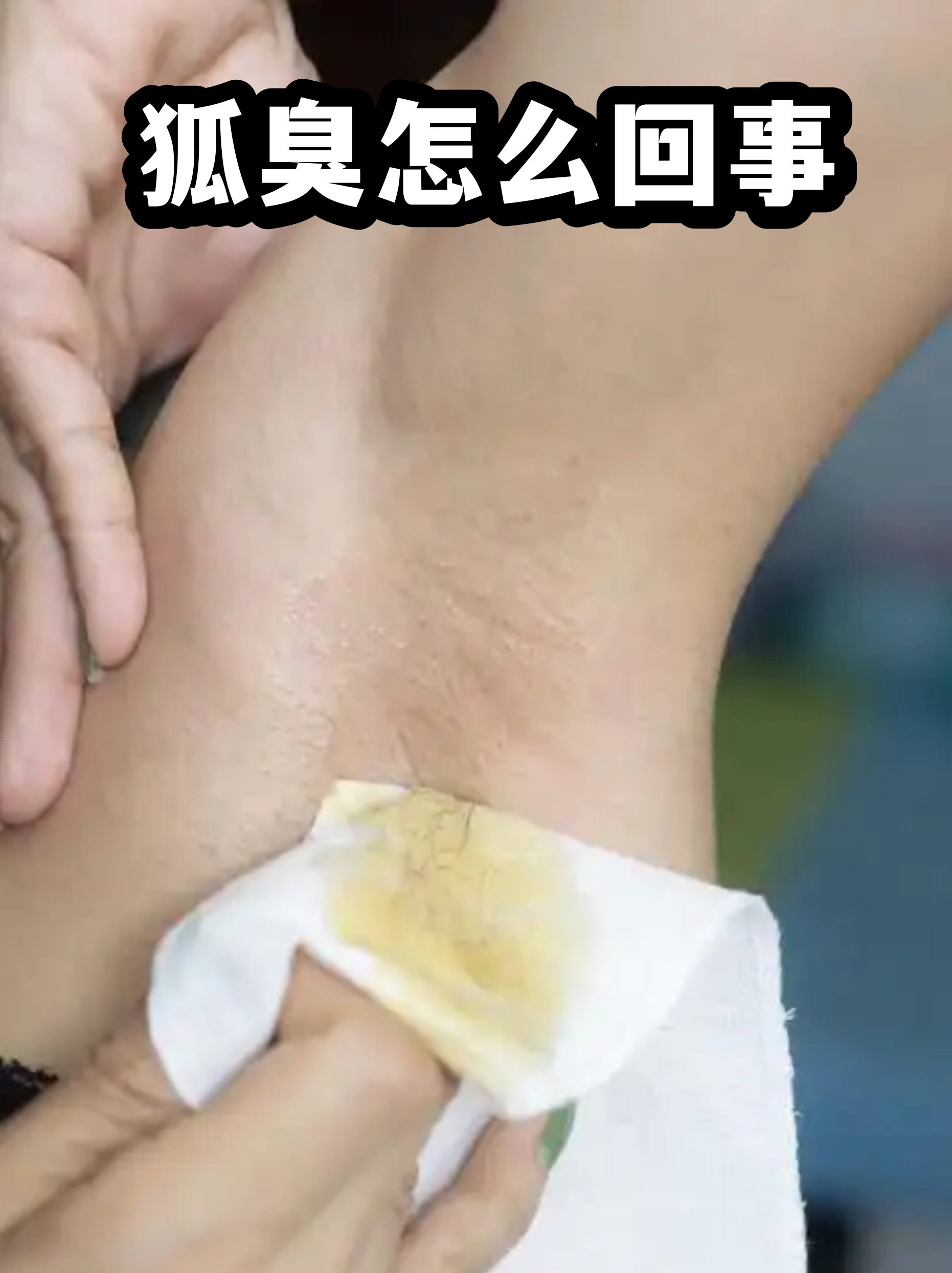 狐臭人的腋窝是什么样(狐臭的腋窝和正常人有区别吗)