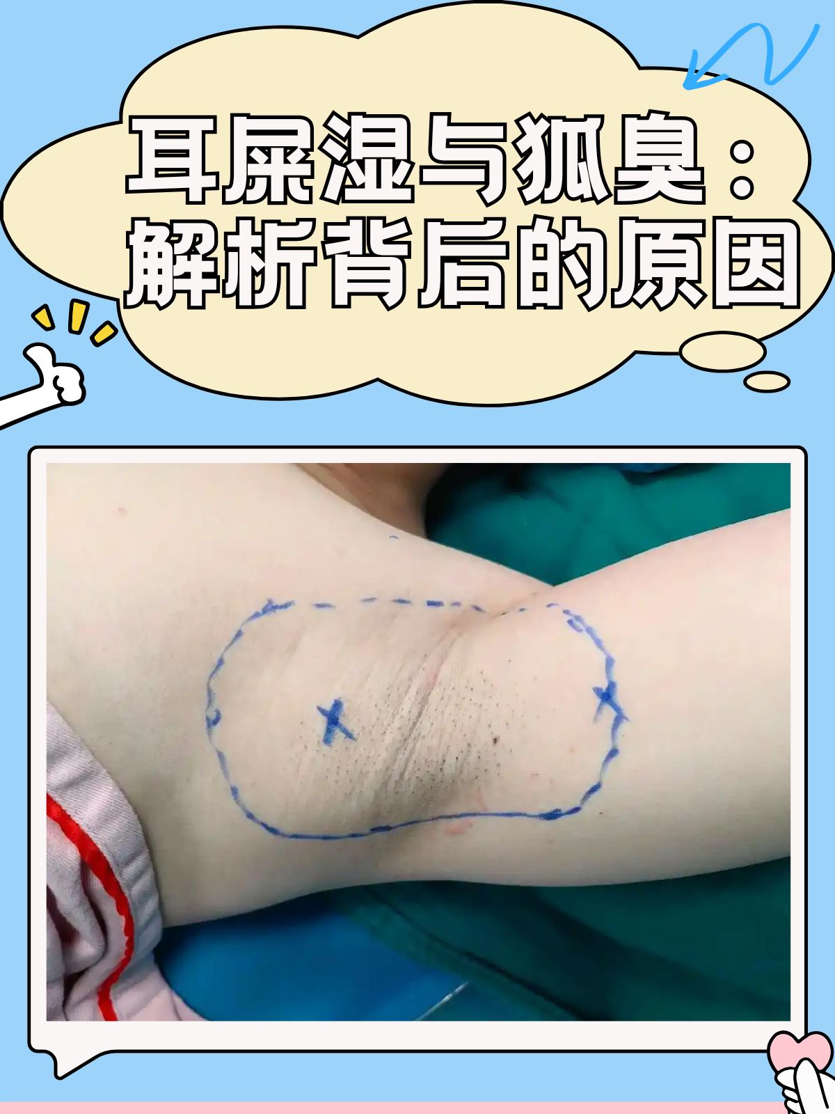 狐臭是上辈子的因果吗(狐臭是上辈子的因果吗女性)
