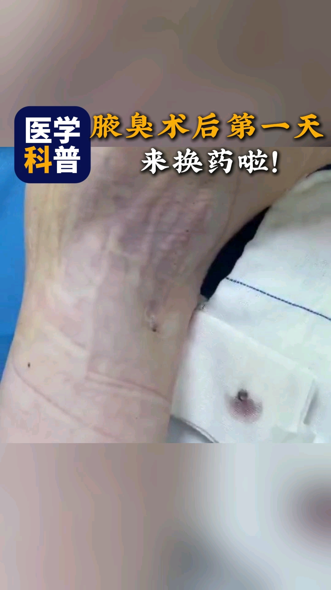 农安狐臭手术(做狐臭手术农村合作医疗可以报销吗) 农安狐臭手术(做狐臭手术农村合作医疗可以报销吗)