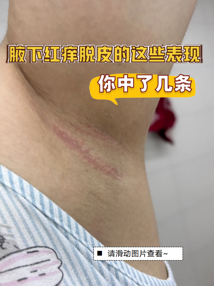 青春期假性狐臭的症状(青春期假性狐臭和狐臭的区别)