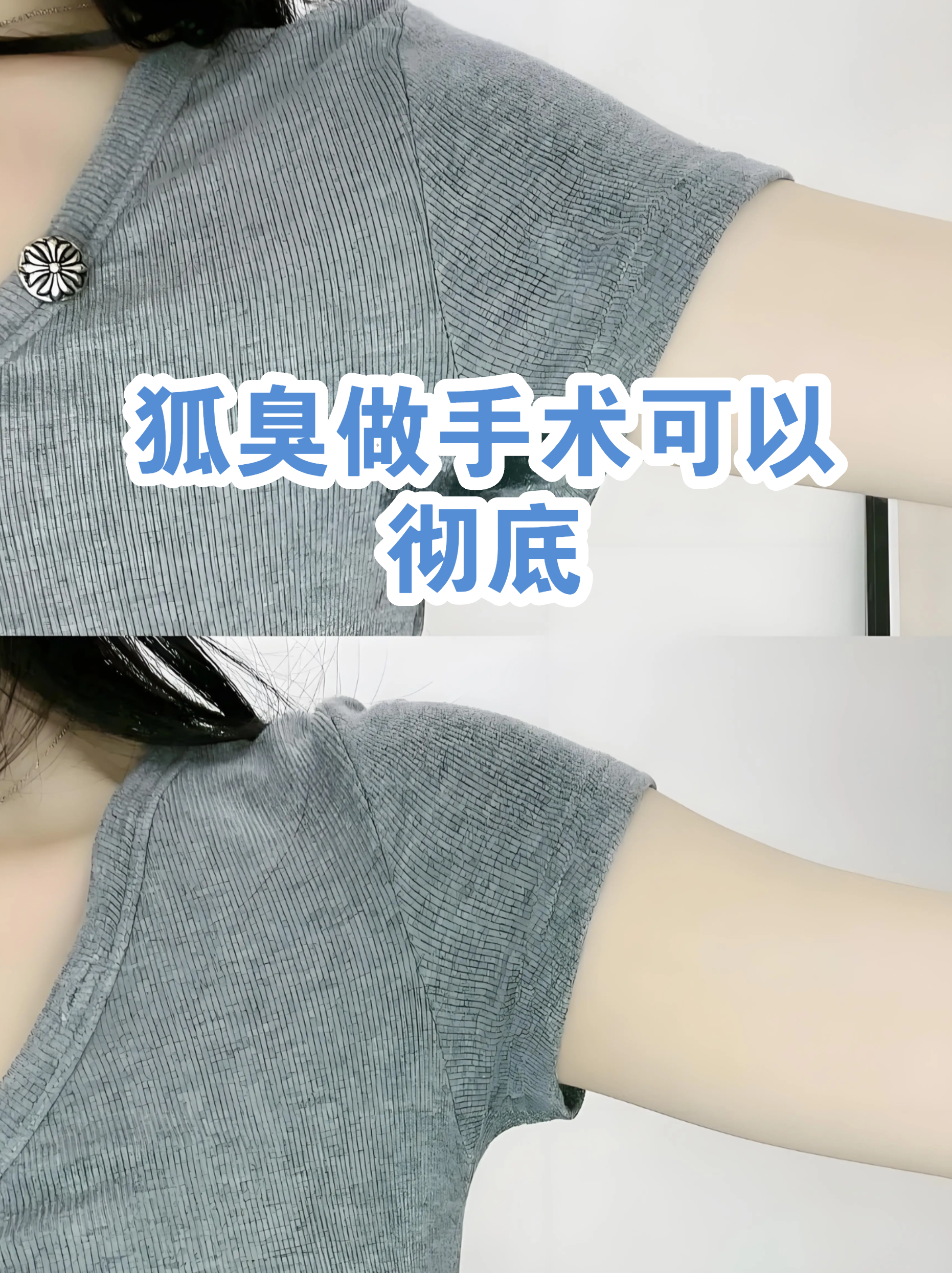 狐臭手术费用贵吗(狐臭手术费用贵吗多少钱)