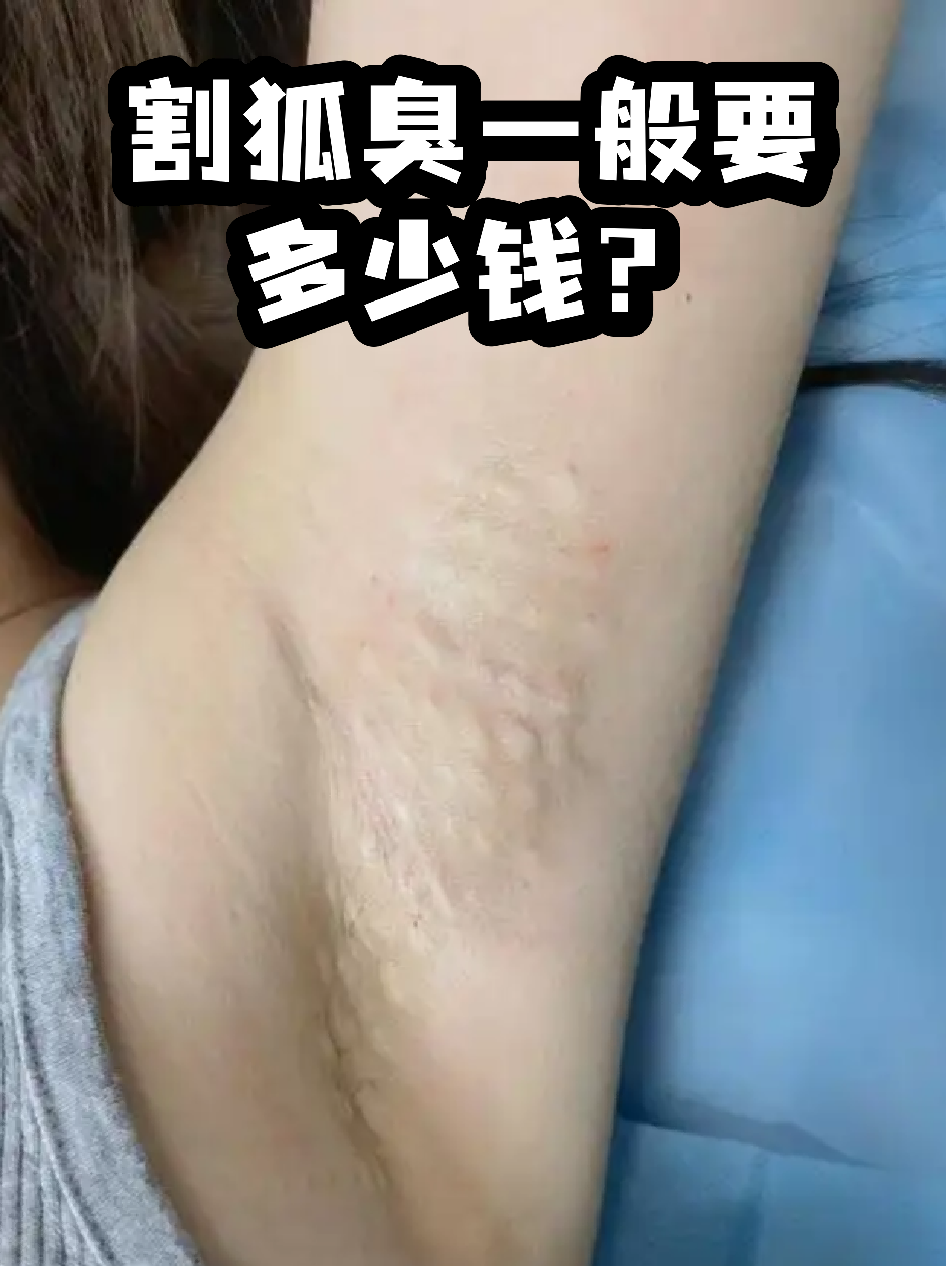 狐臭手术一般费用多少可以报销吗(狐臭手术一般费用多少可以报销吗?)