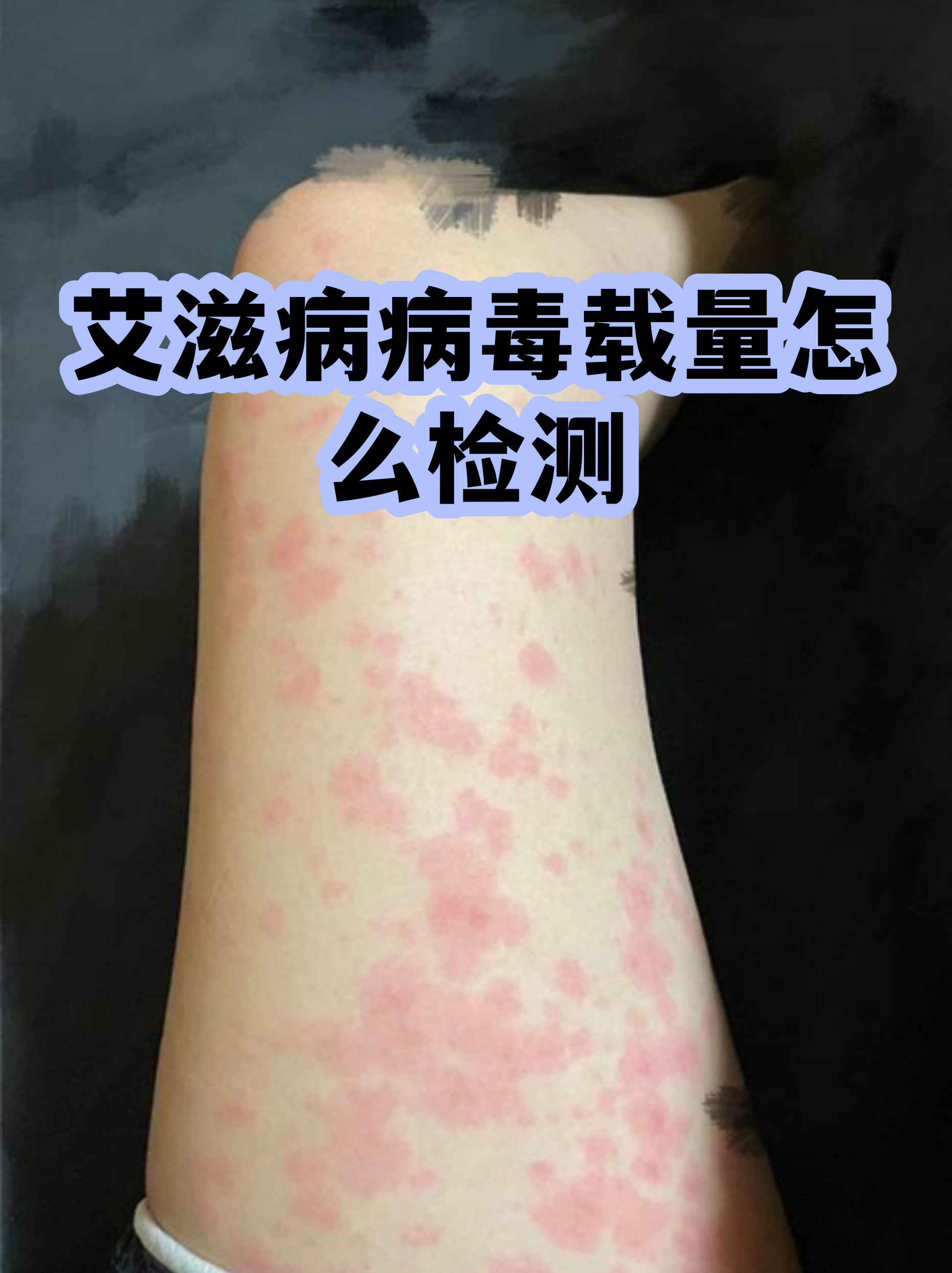 艾滋病第四代检测多久可以出结果(第四代艾滋病联合检测30天准确吗)