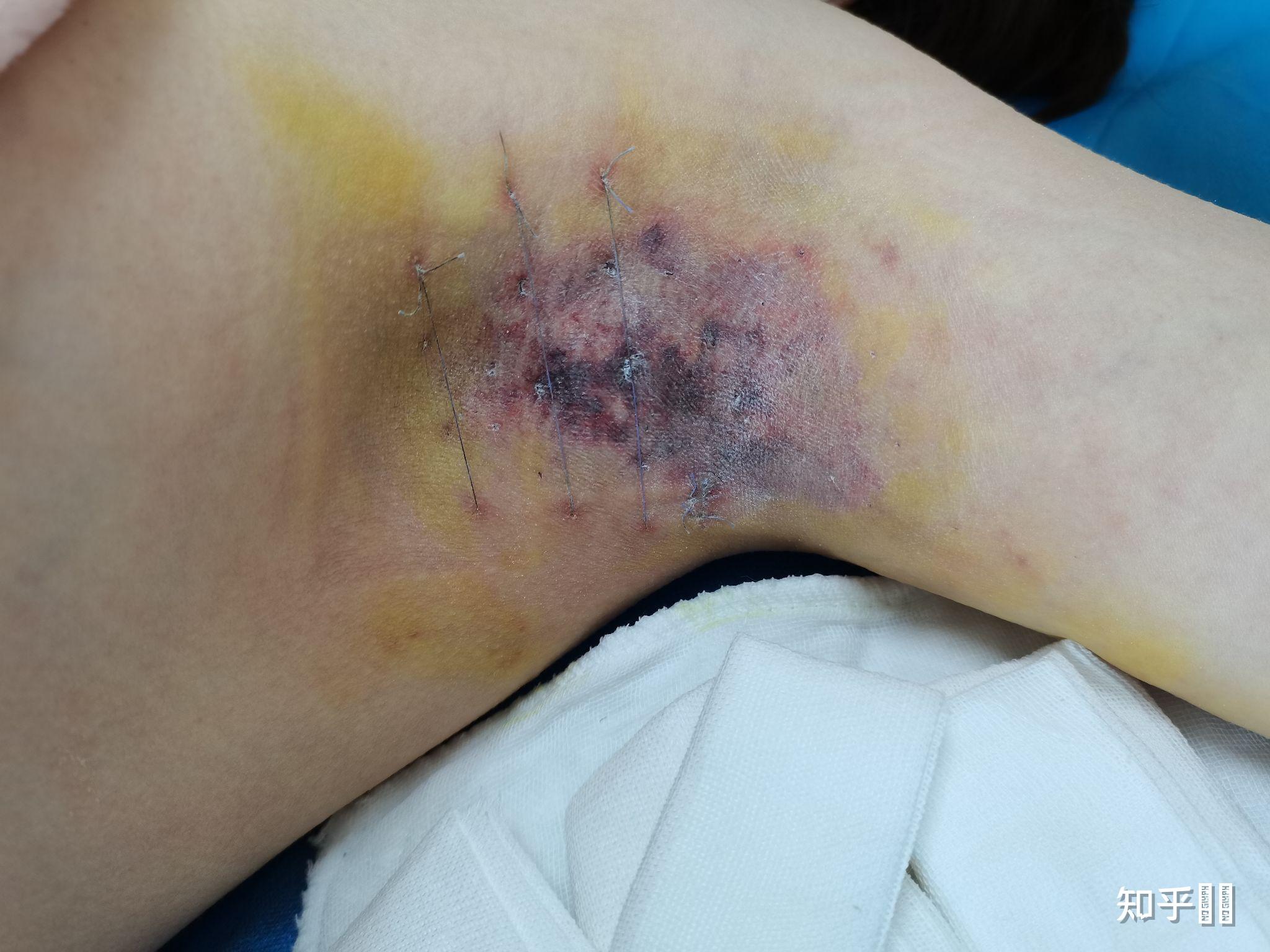 有狐臭可以当兵吗女生怎么办(有狐臭可以当兵吗女生怎么办呢) 有狐臭可以当兵吗女生怎么办(有狐臭可以当兵吗女生怎么办呢)