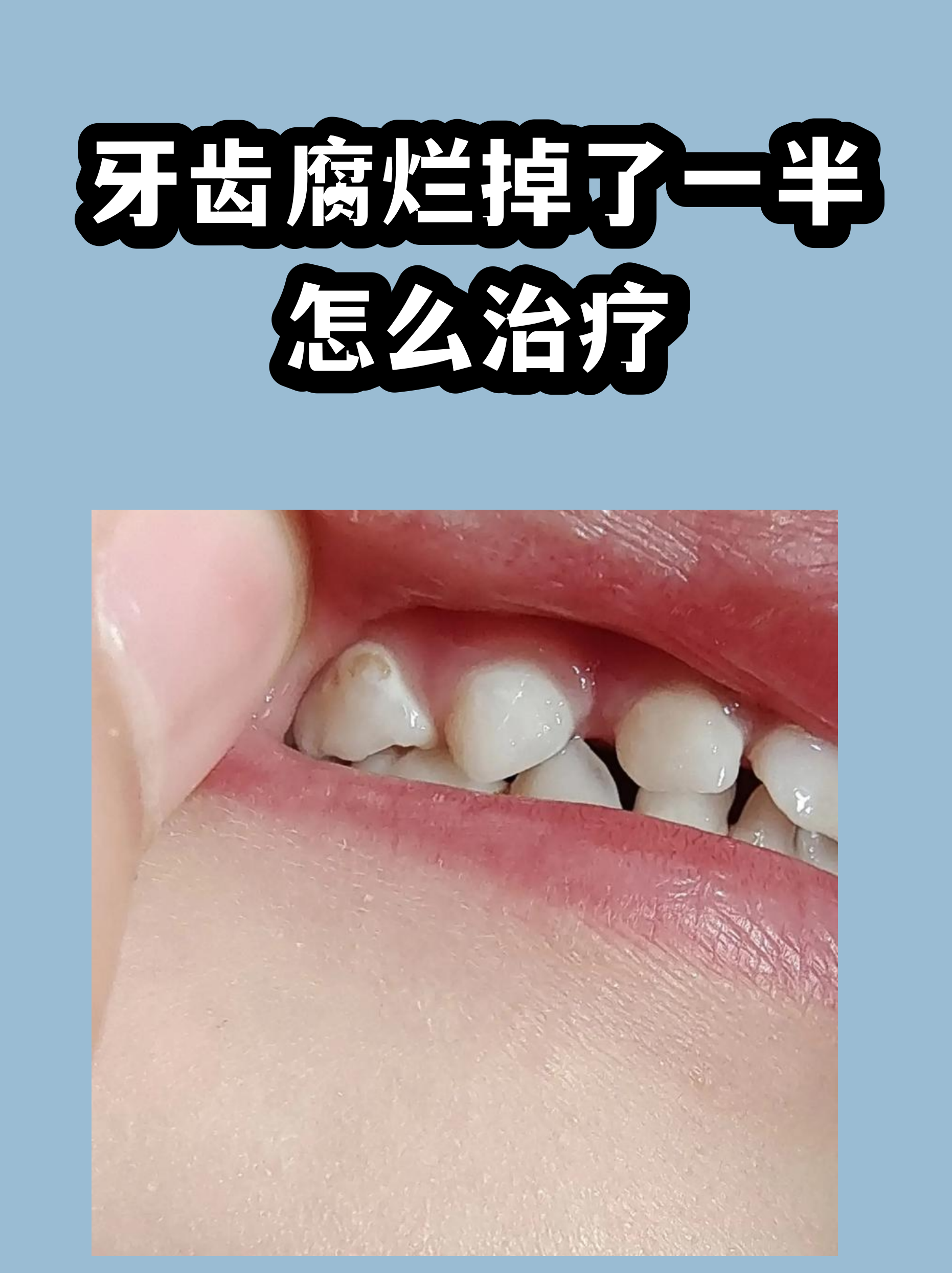 周公解梦全解查询牙齿掉了一颗(周公解梦全解查询牙齿掉了一颗什么意思)
