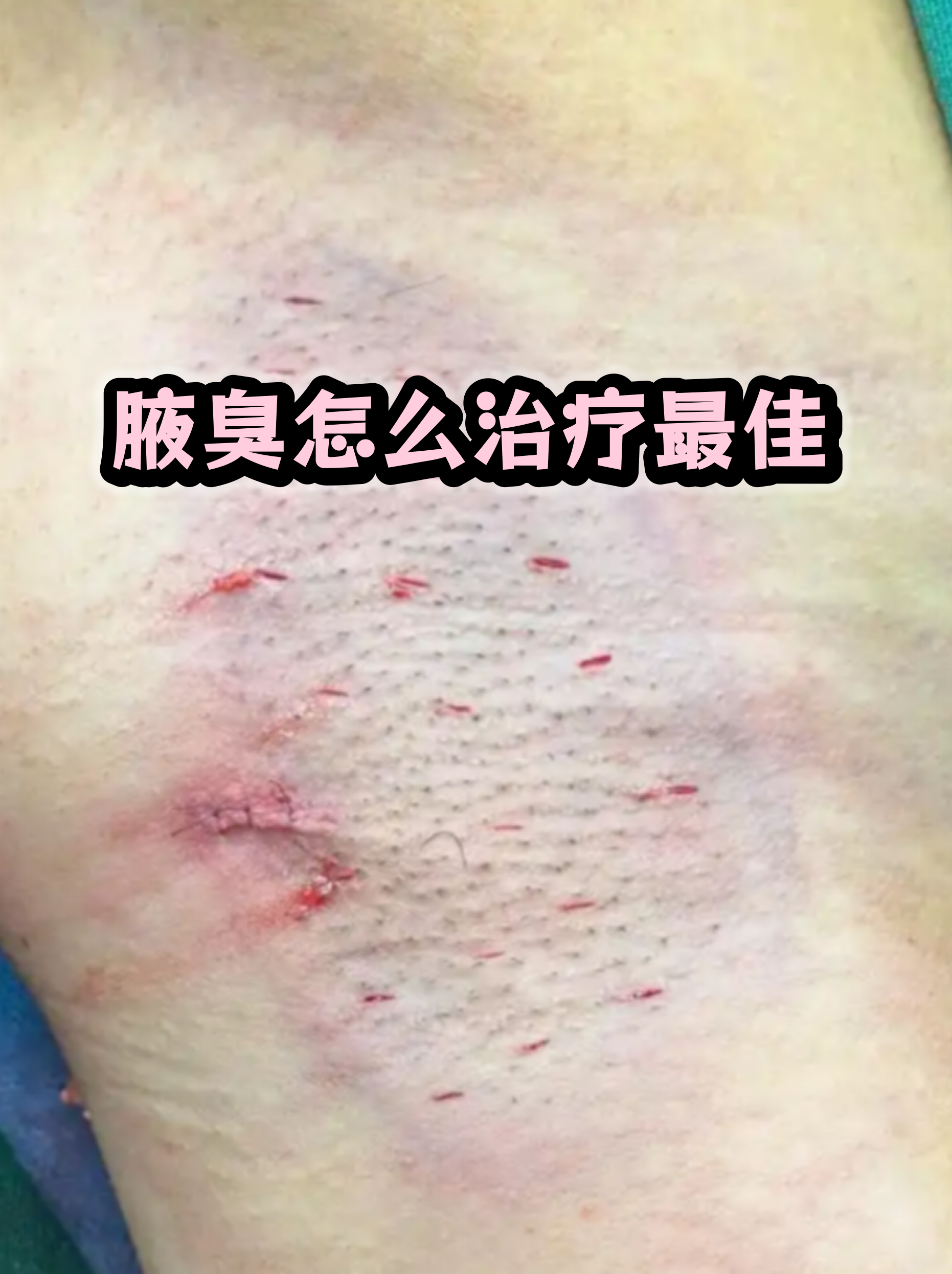 狐臭和普通腋臭哪个更严重(狐臭和腋臭永久根除最好方法)