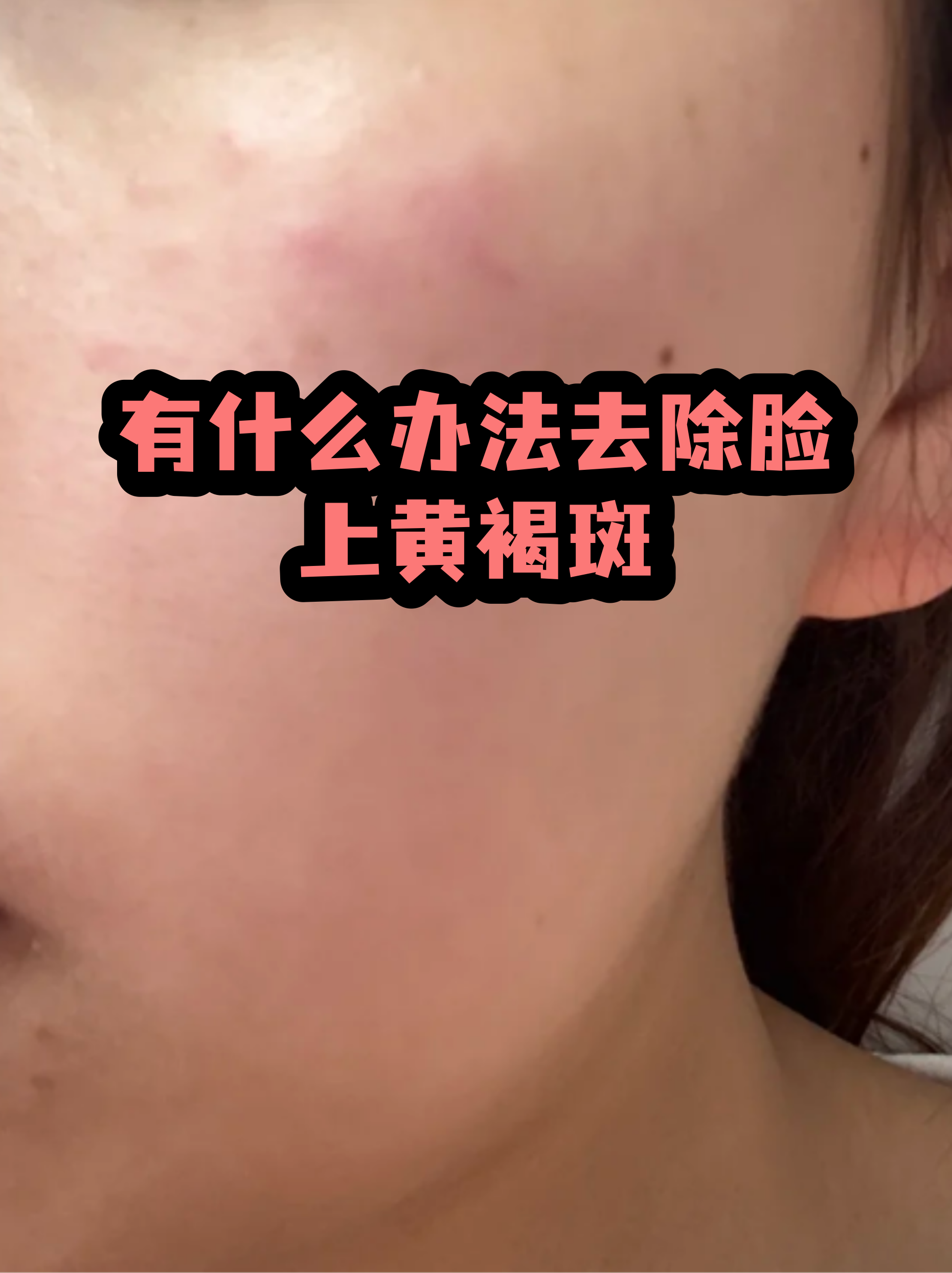 脸上长黄褐斑看什么科(脸上长黄褐斑看什么科1)