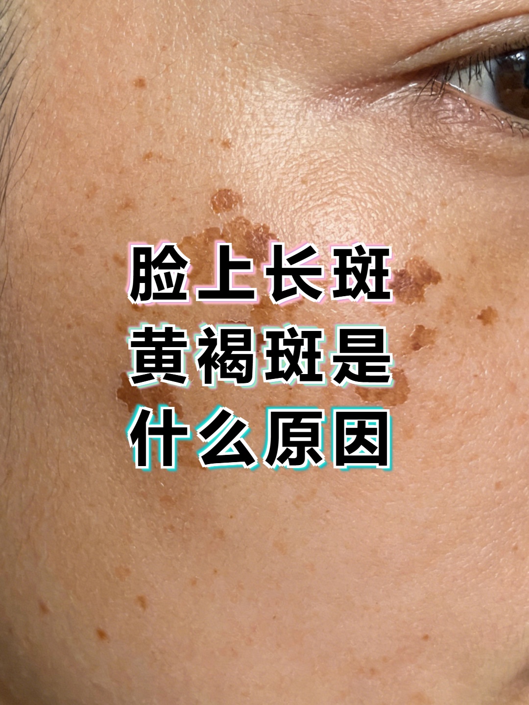 脸上长黄褐斑看什么科(脸上长黄褐斑看什么科一)