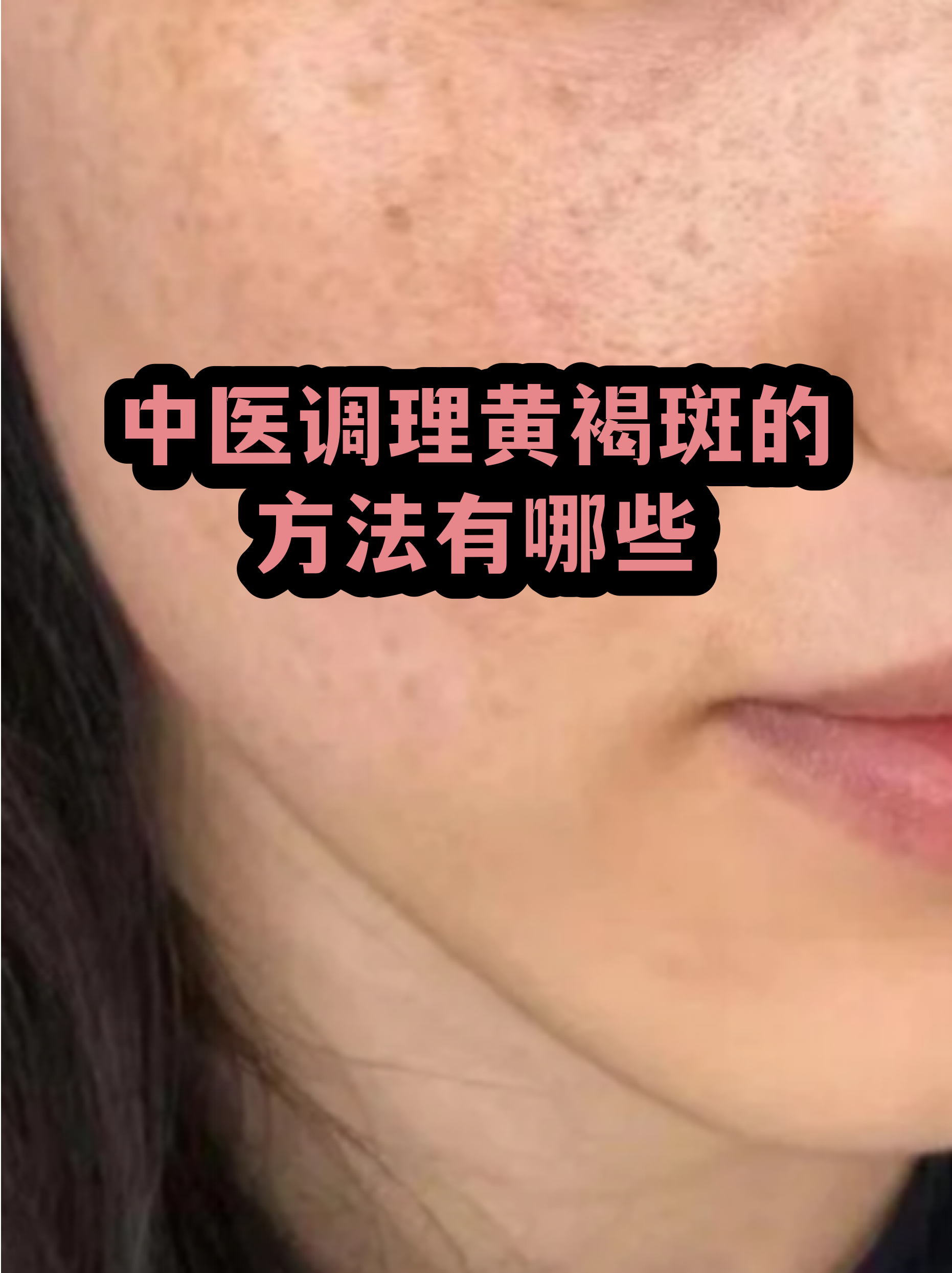 脸上长黄褐斑看什么科(脸上长黄褐斑看什么科一) 脸上长黄褐斑看什么科(脸上长黄褐斑看什么科一)